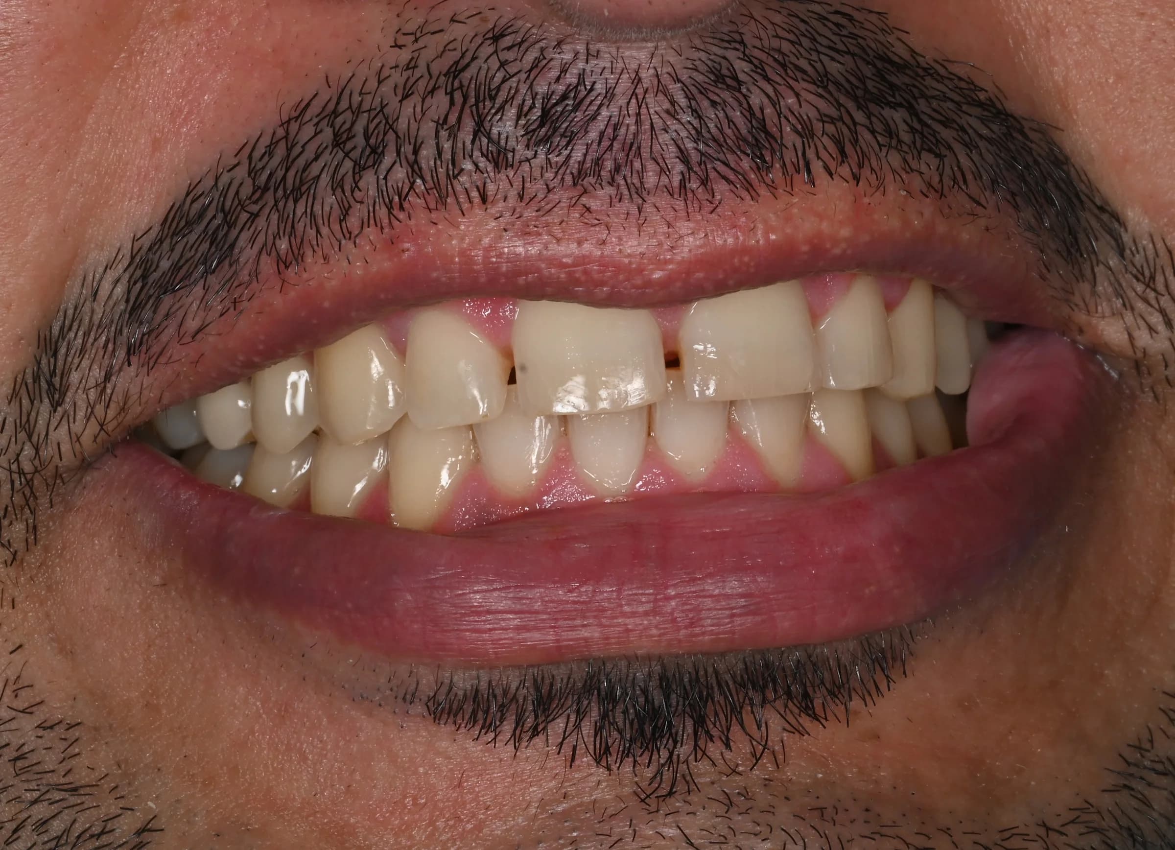 Whitening across both arches, shade matched — before treatment