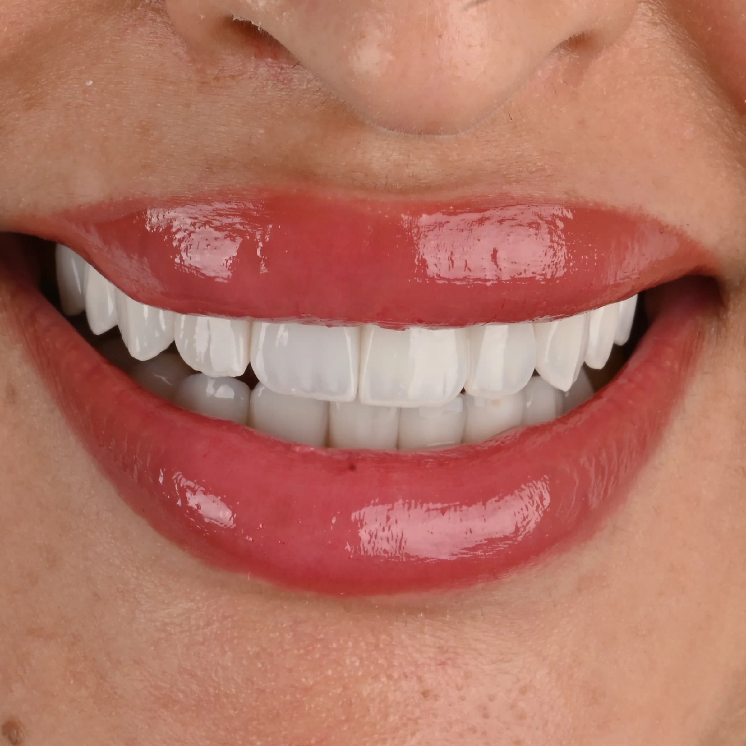 Veneers documented across five views — photo 3