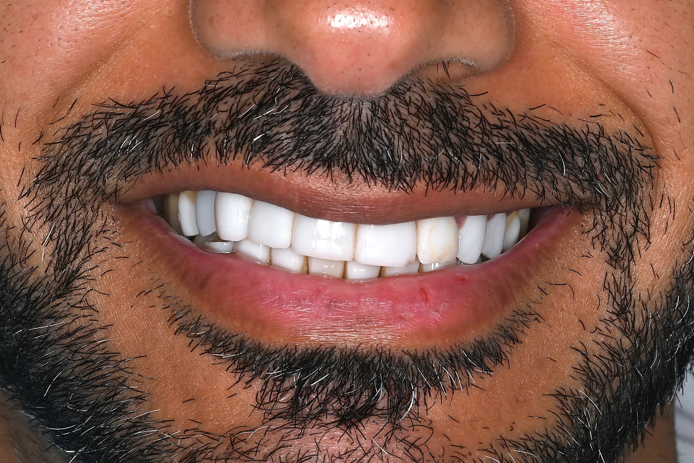 A full veneer case, six views — before treatment
