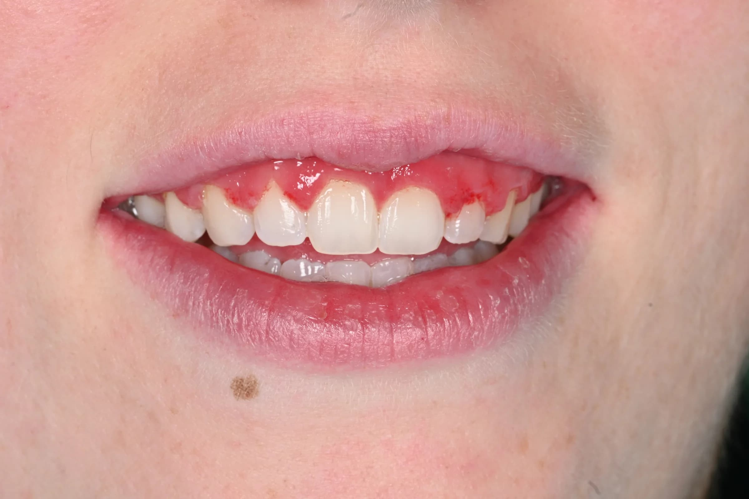 Reshaping a gummy smile — before treatment