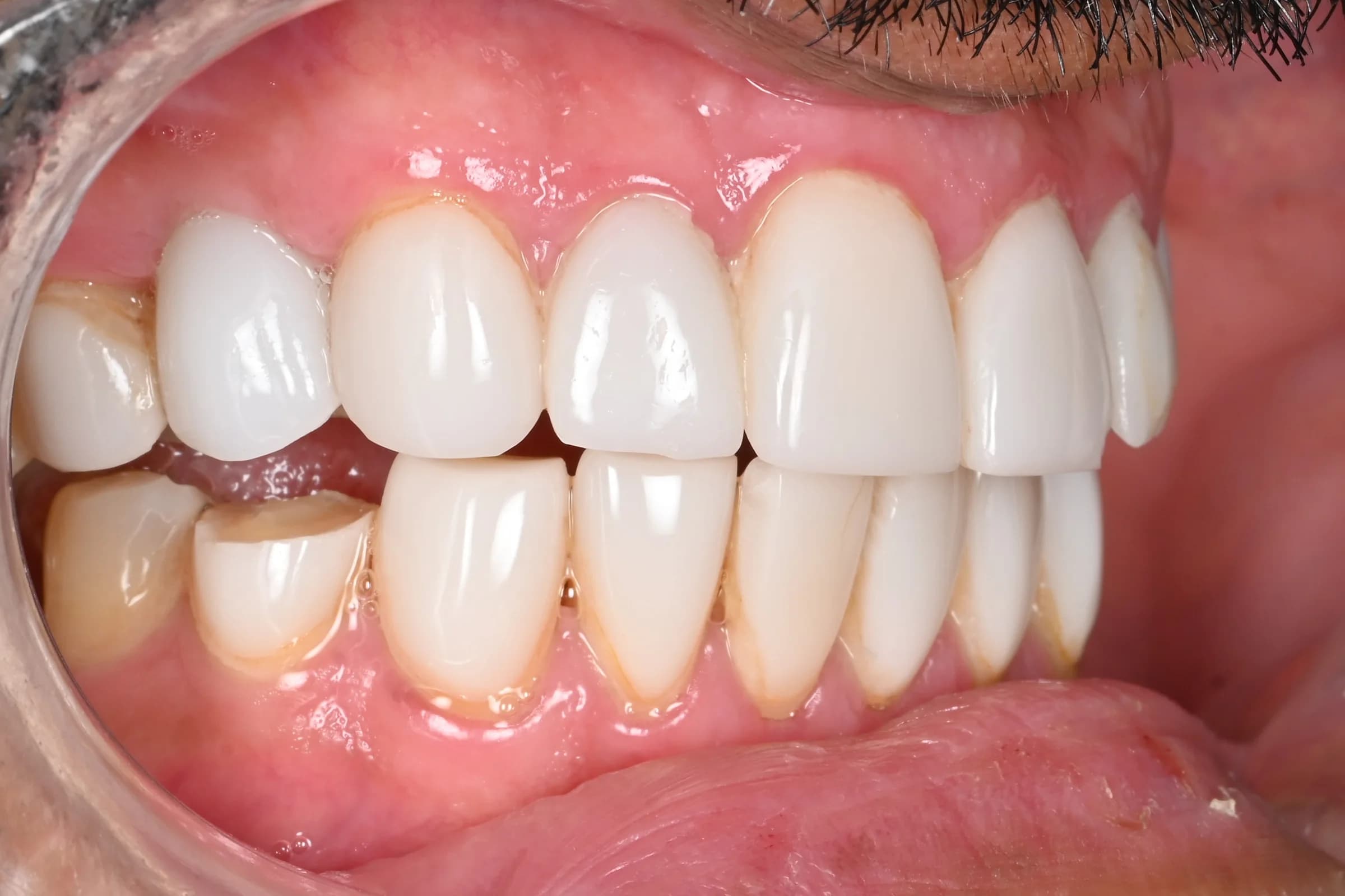A full veneer case, six views — before treatment