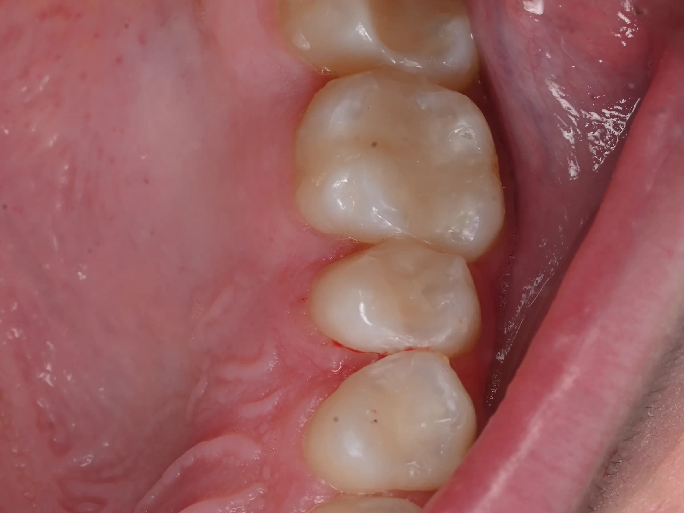 Fillings that match the tooth — after treatment