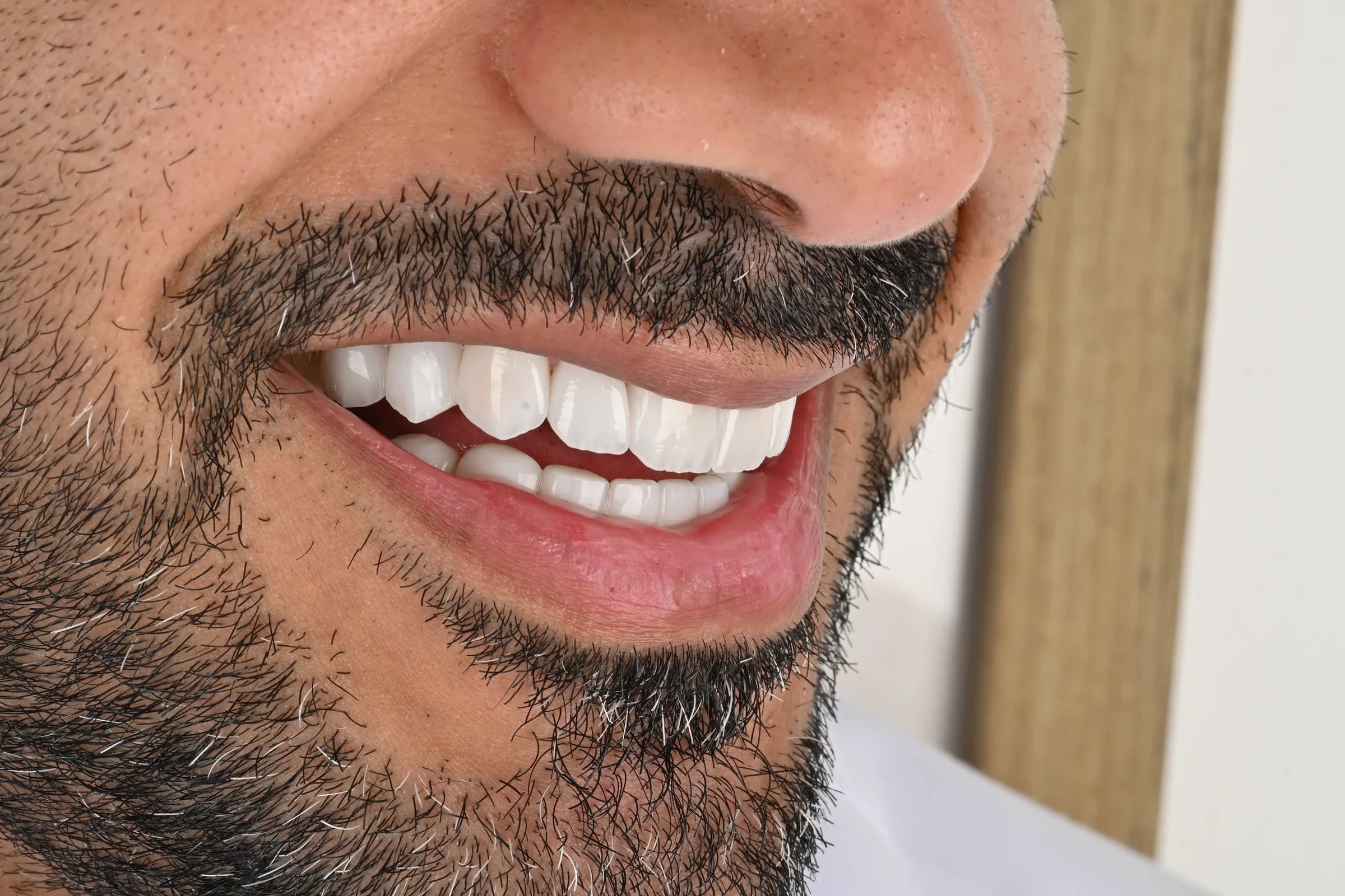 A full veneer case, six views — after treatment