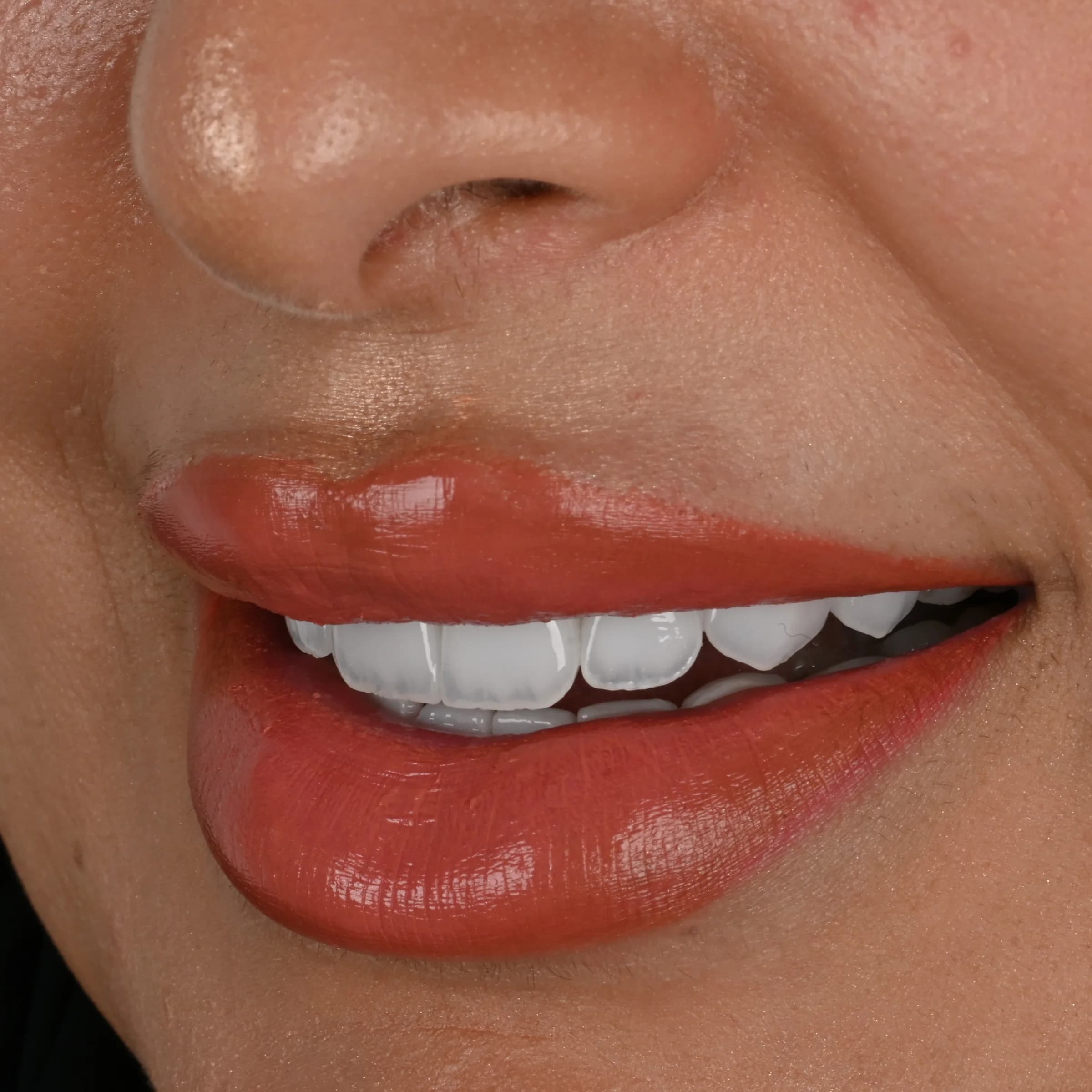 Porcelain veneers, upper and lower — after treatment