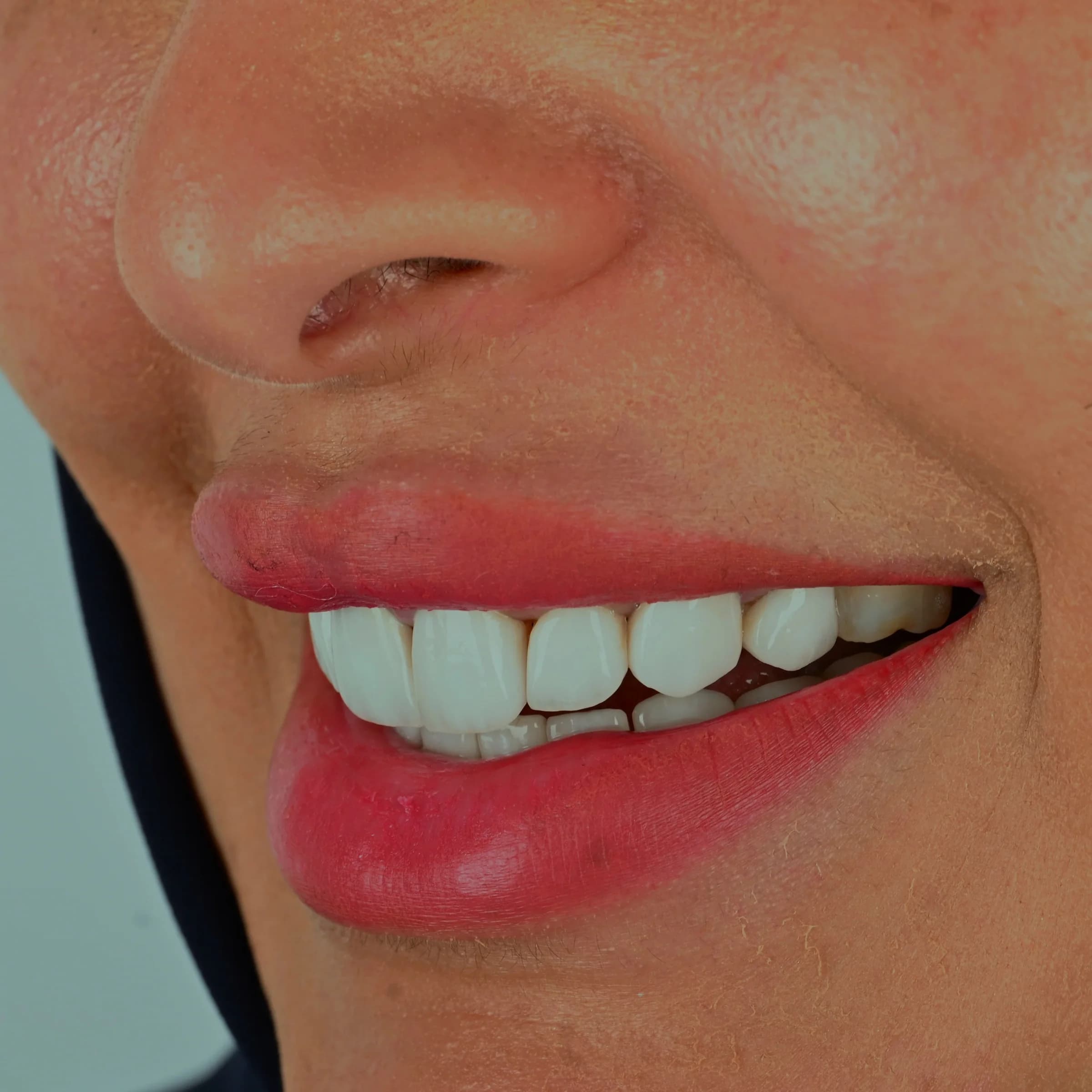 Porcelain veneers, upper and lower — before treatment