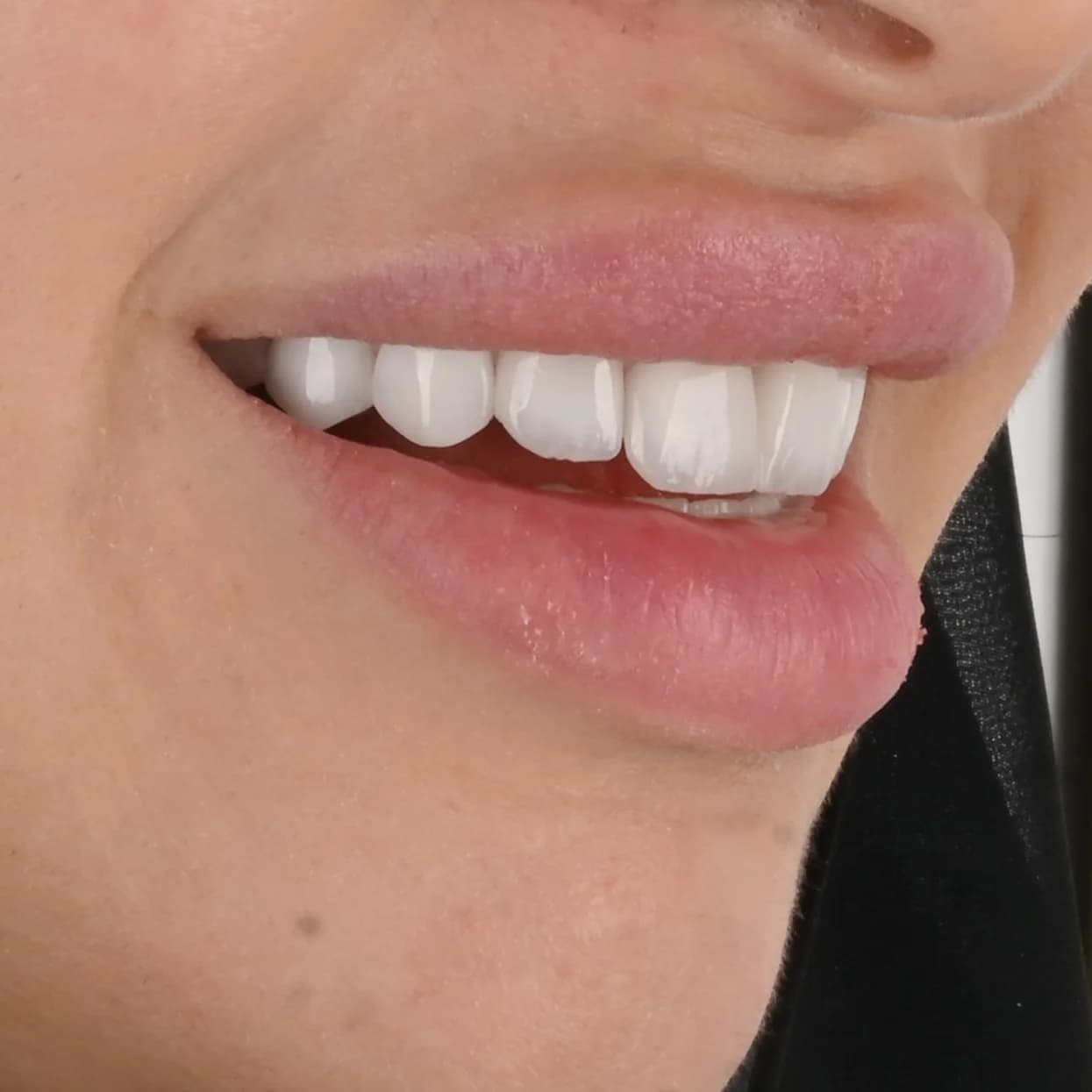 Replacing older veneers and crowns — photo 5