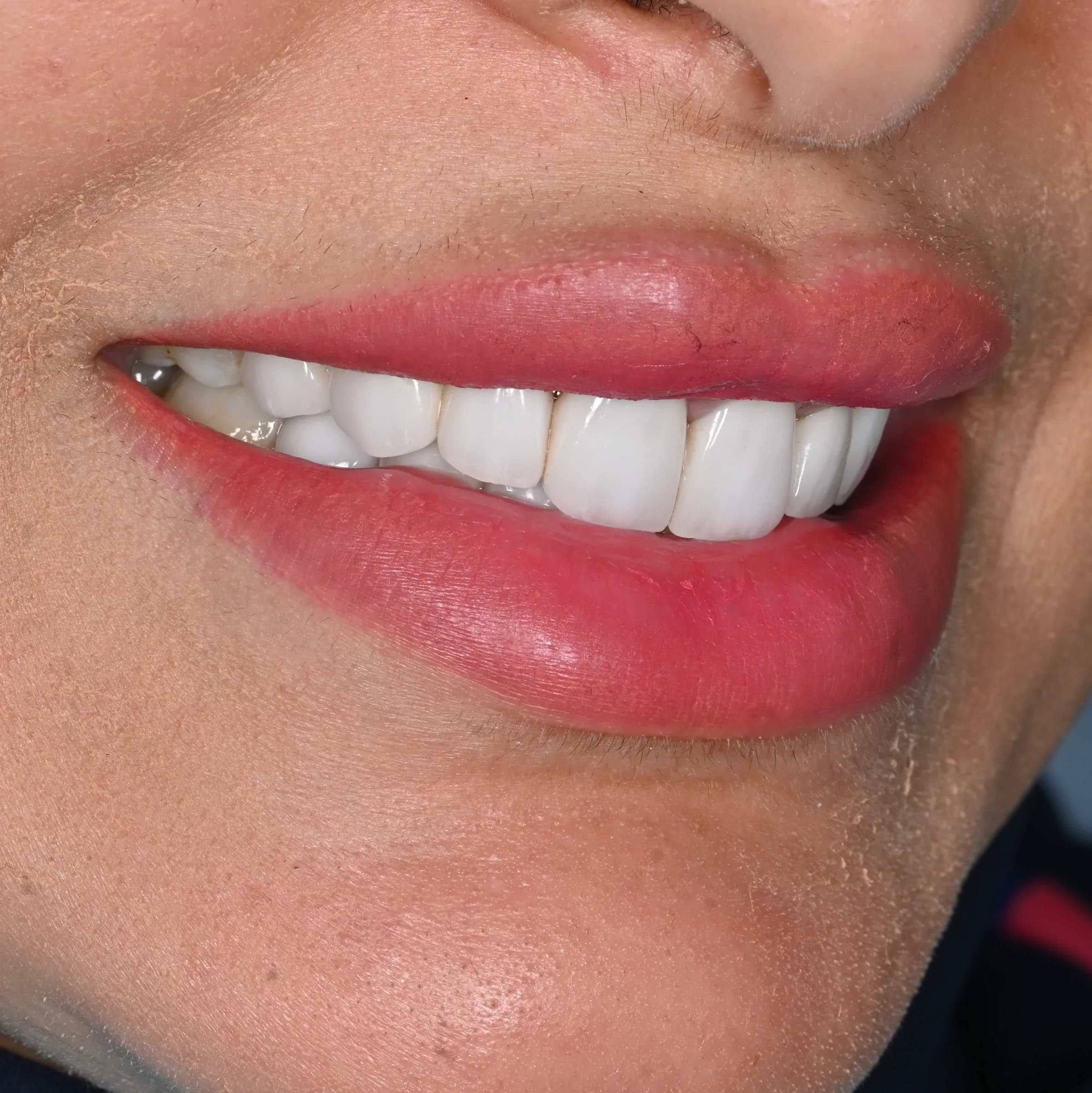 Porcelain veneers, upper and lower — before treatment