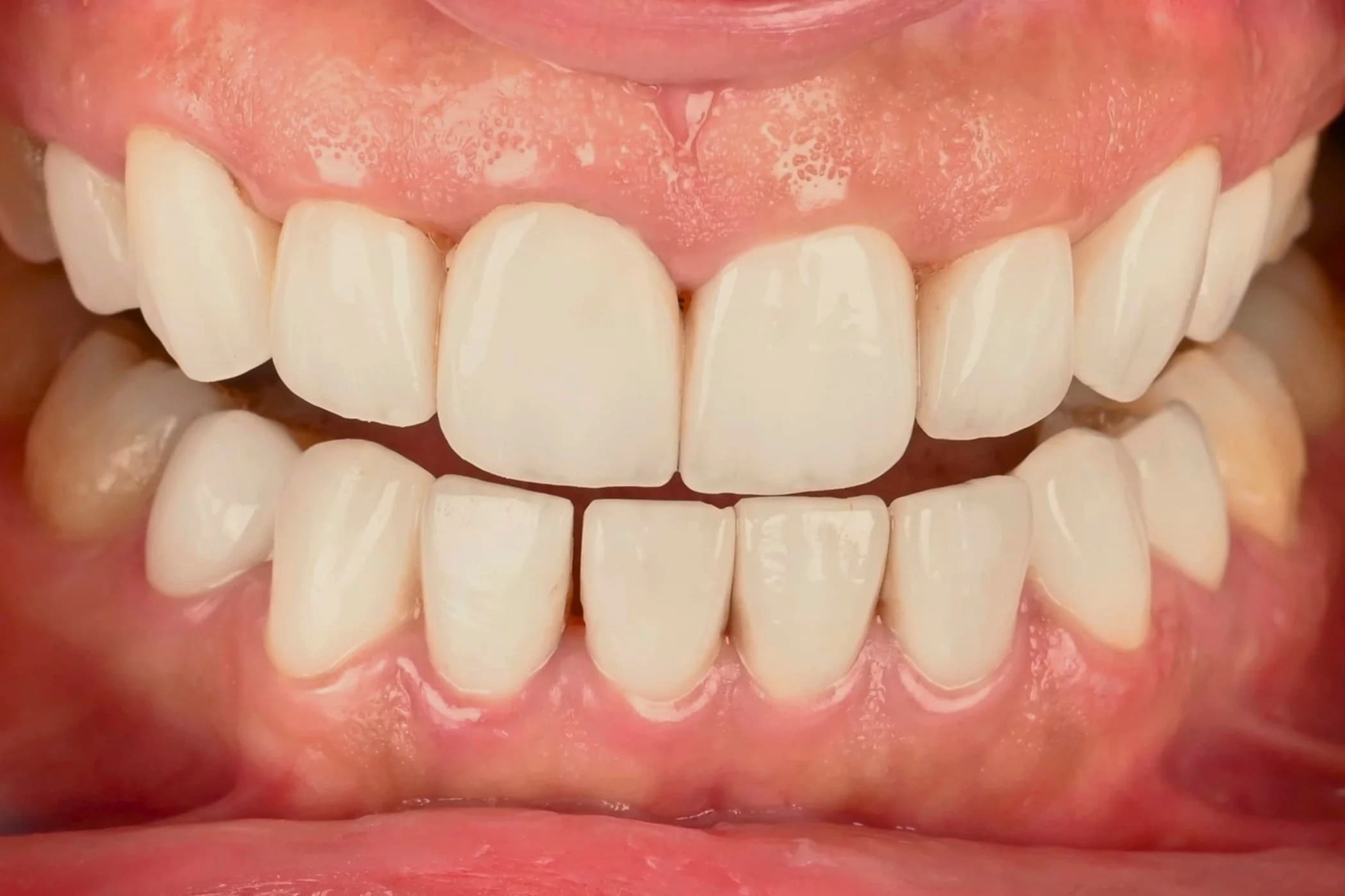 Porcelain veneers, upper and lower — before treatment