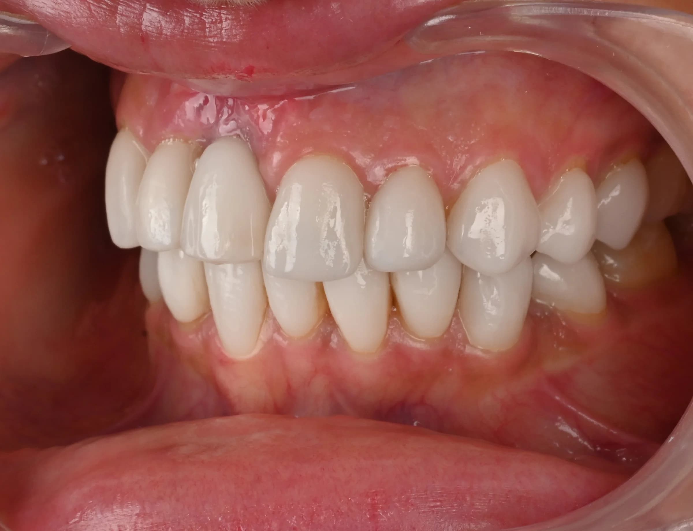 Veneers documented across five views — before treatment