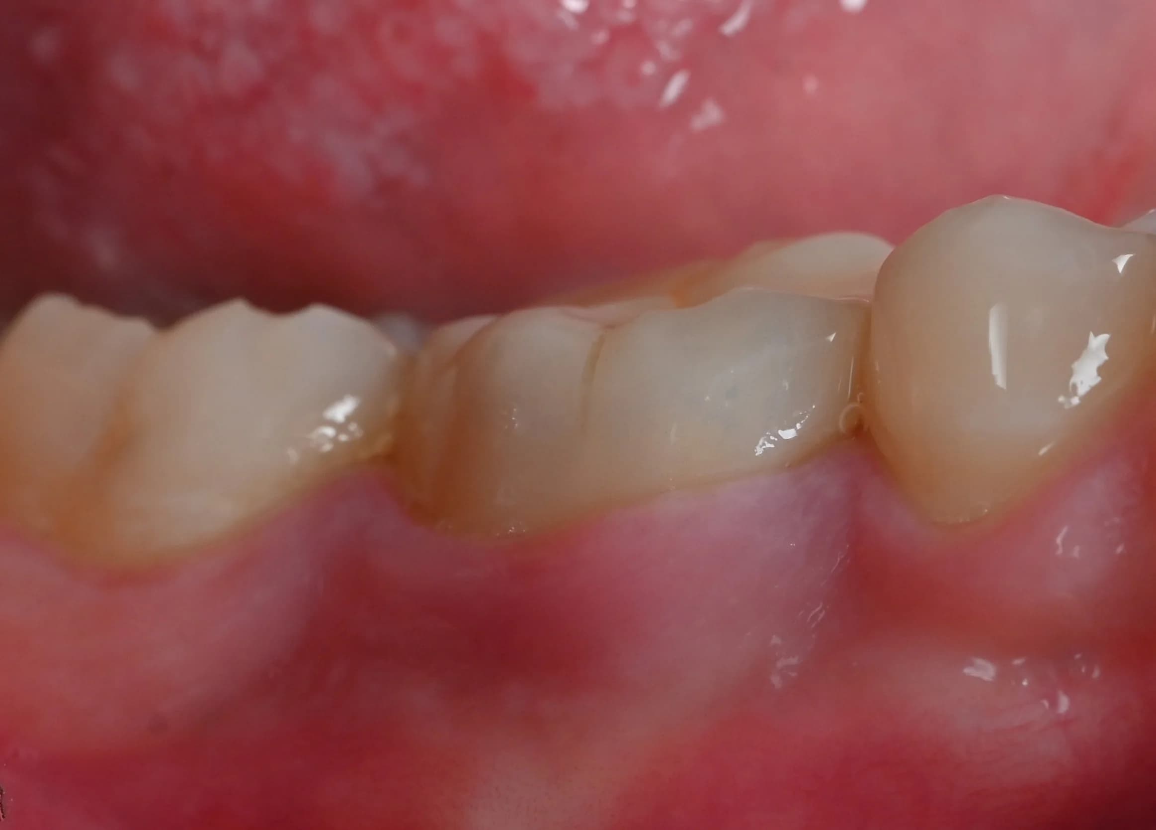 A crown matched to the teeth beside it — after treatment