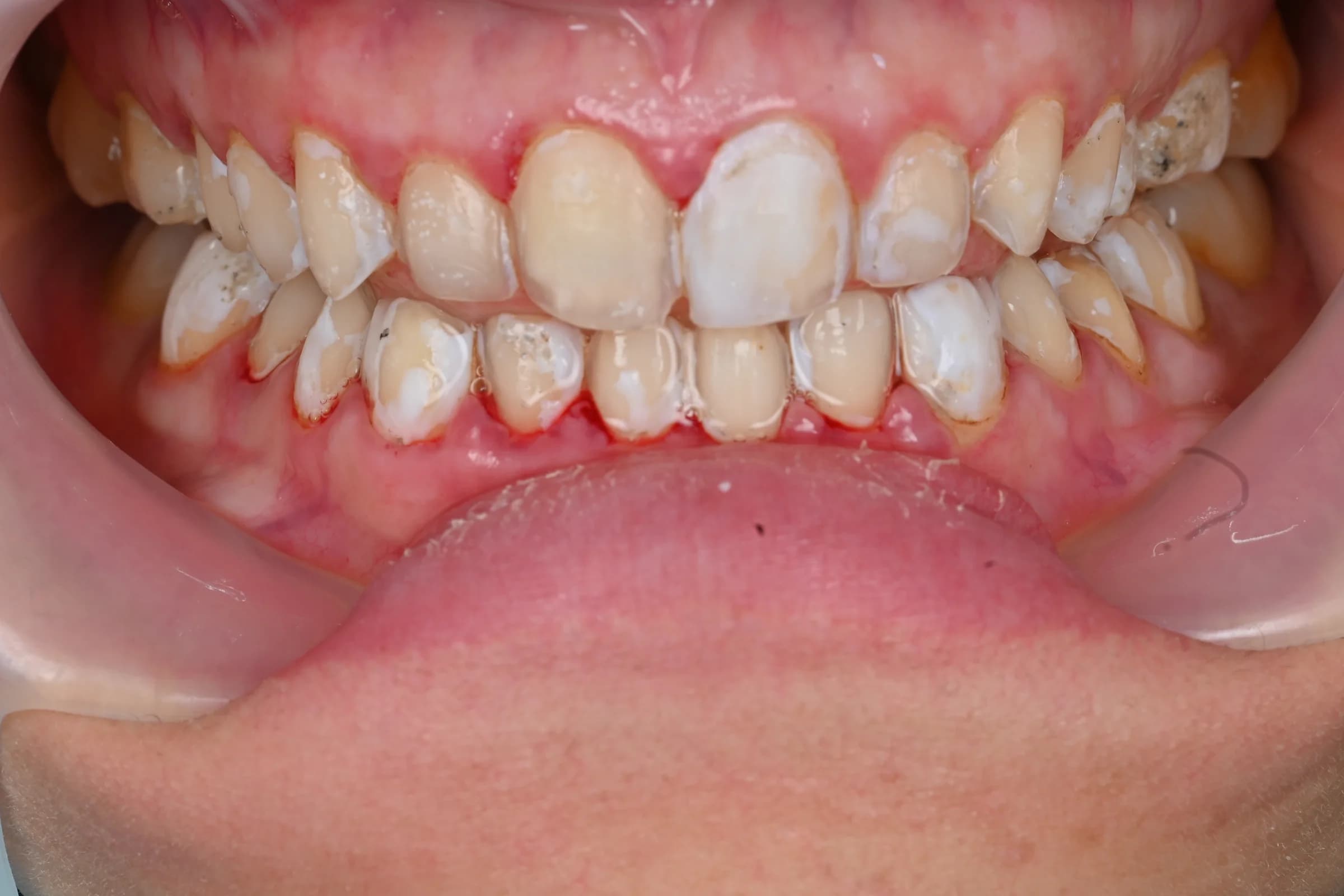 Veneers on the upper front teeth — before treatment