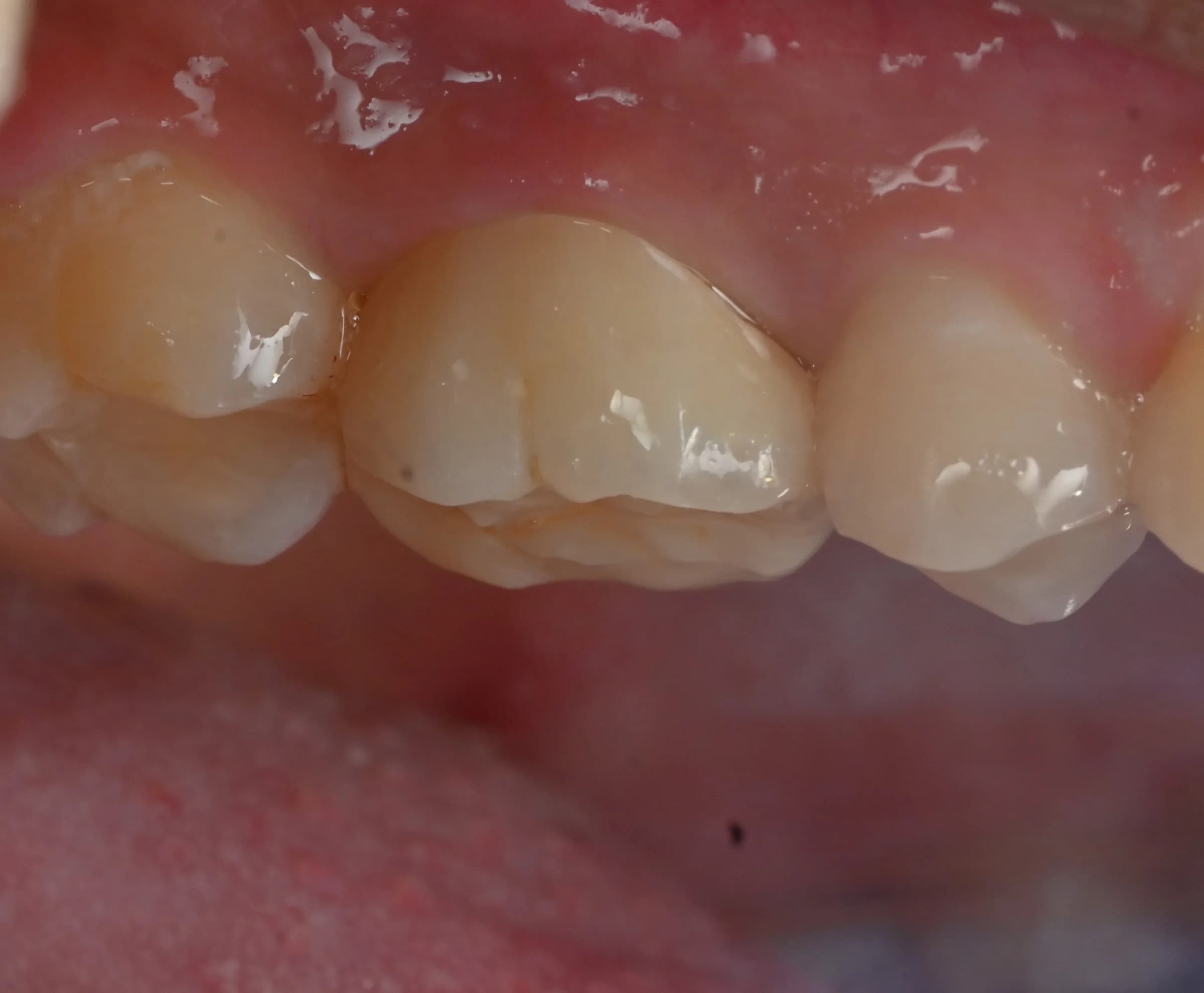 Rebuilding a worn tooth — after treatment