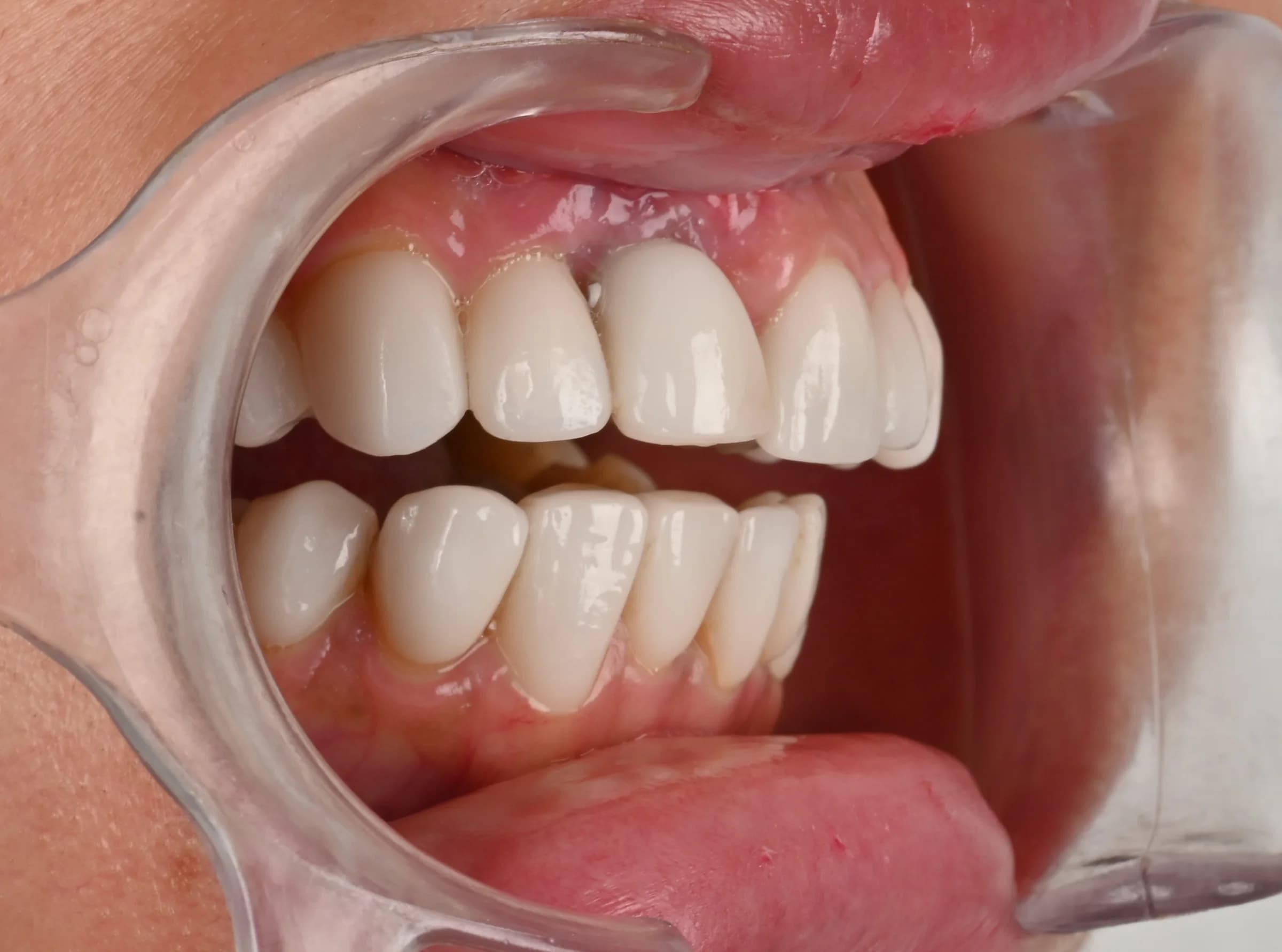 Veneers documented across five views — before treatment
