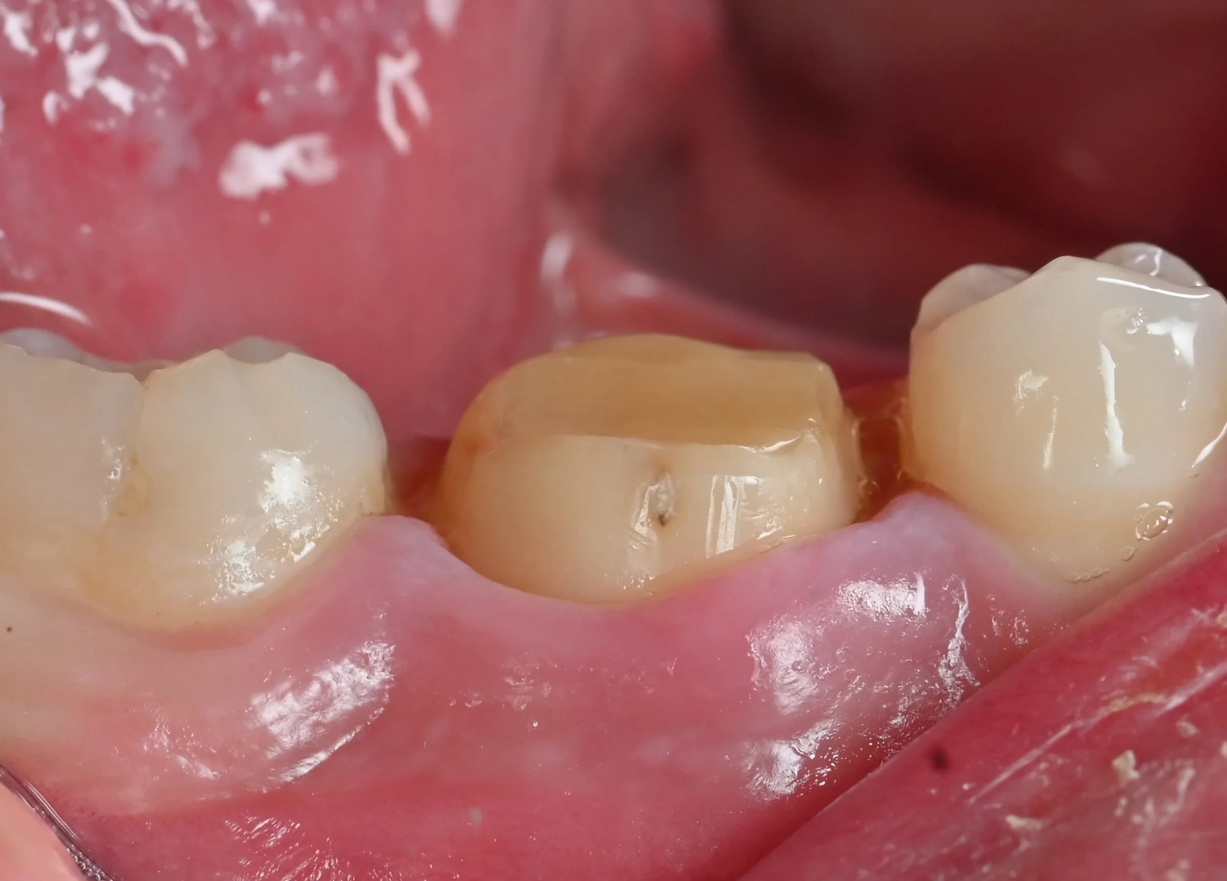 A crown matched to the teeth beside it — before treatment