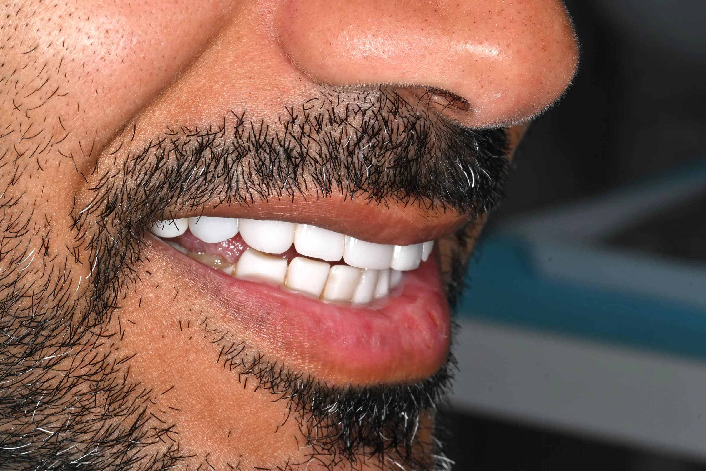 A full veneer case, six views — before treatment
