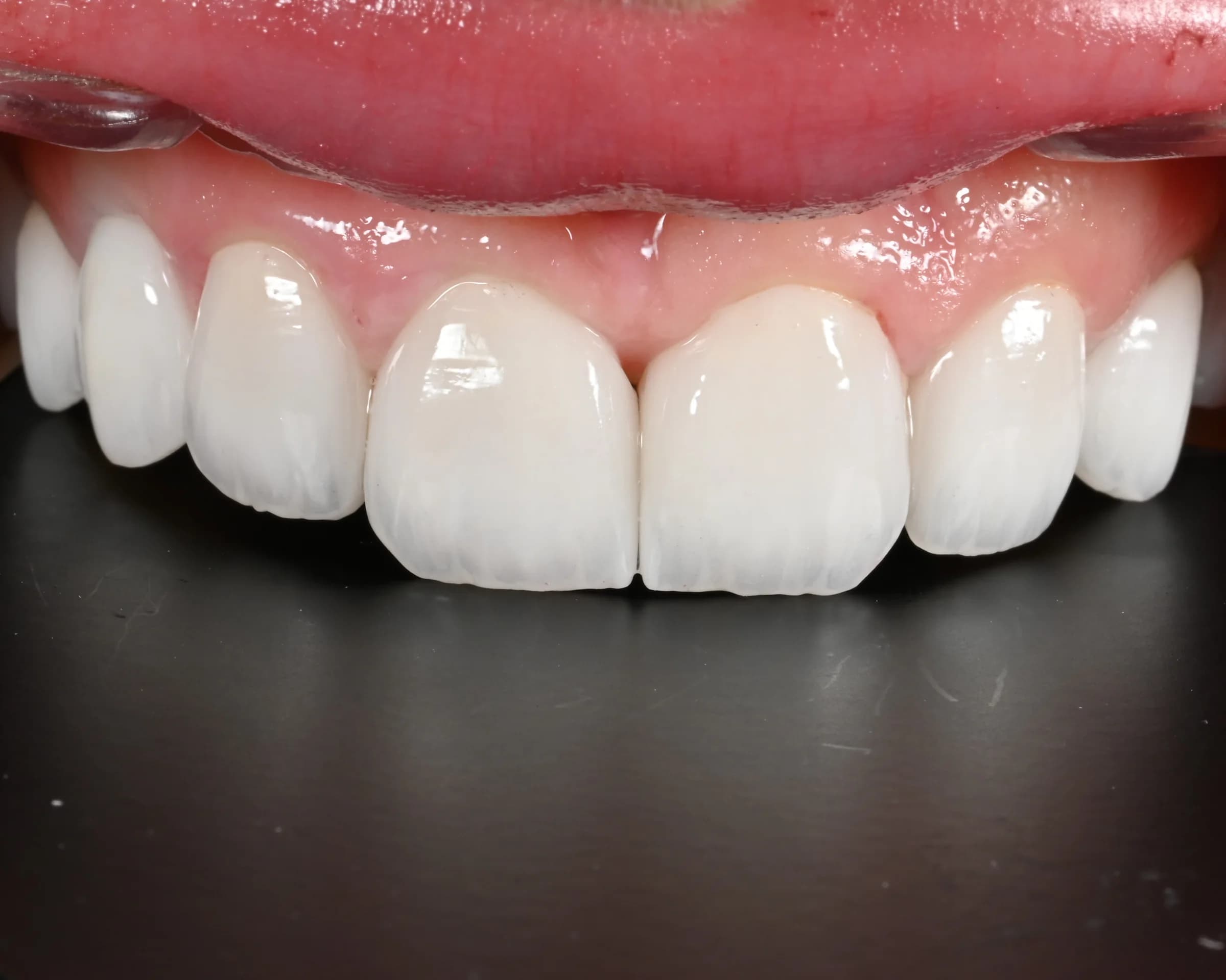 Replacing older veneers and crowns — after treatment