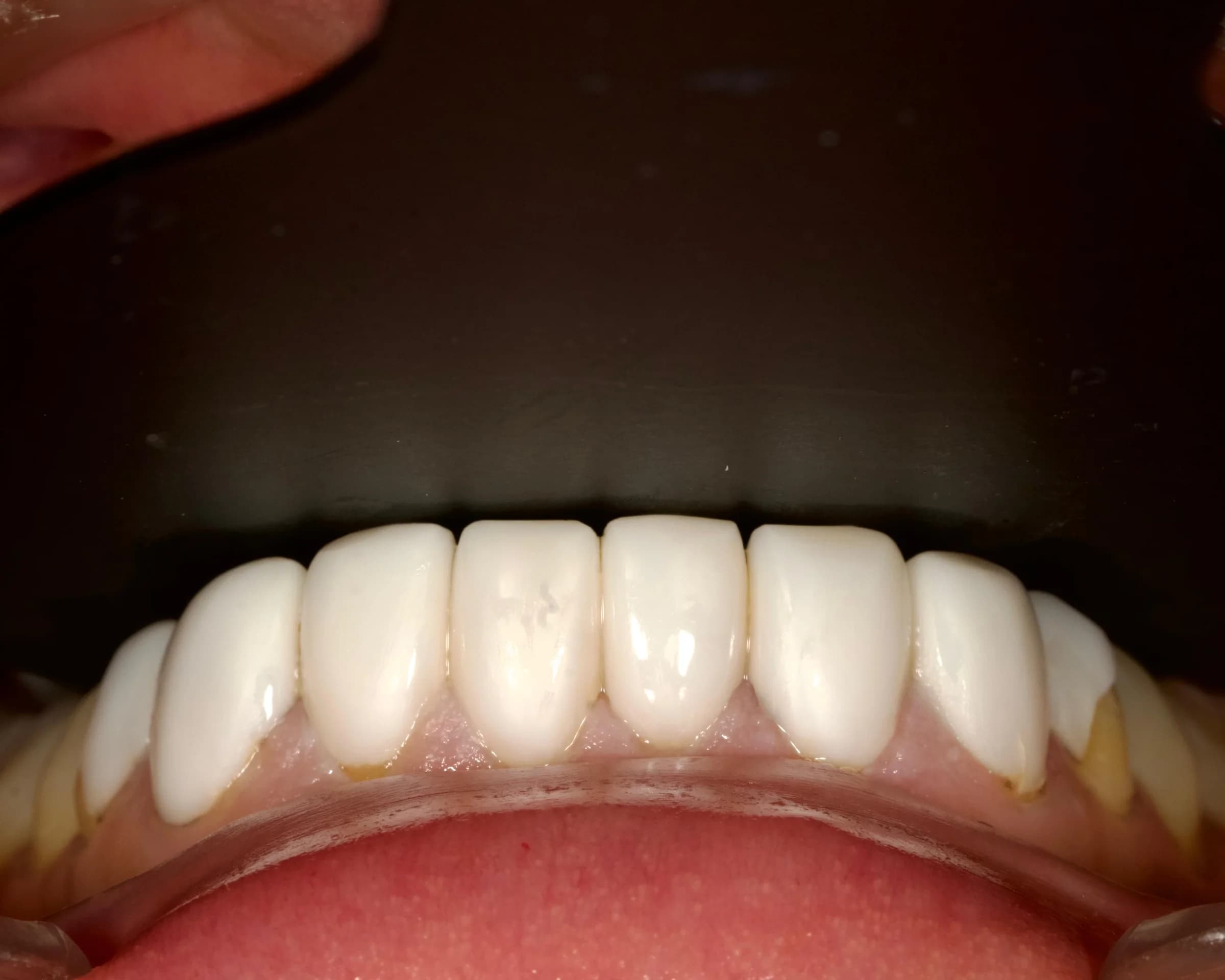 Replacing older veneers and crowns — before treatment