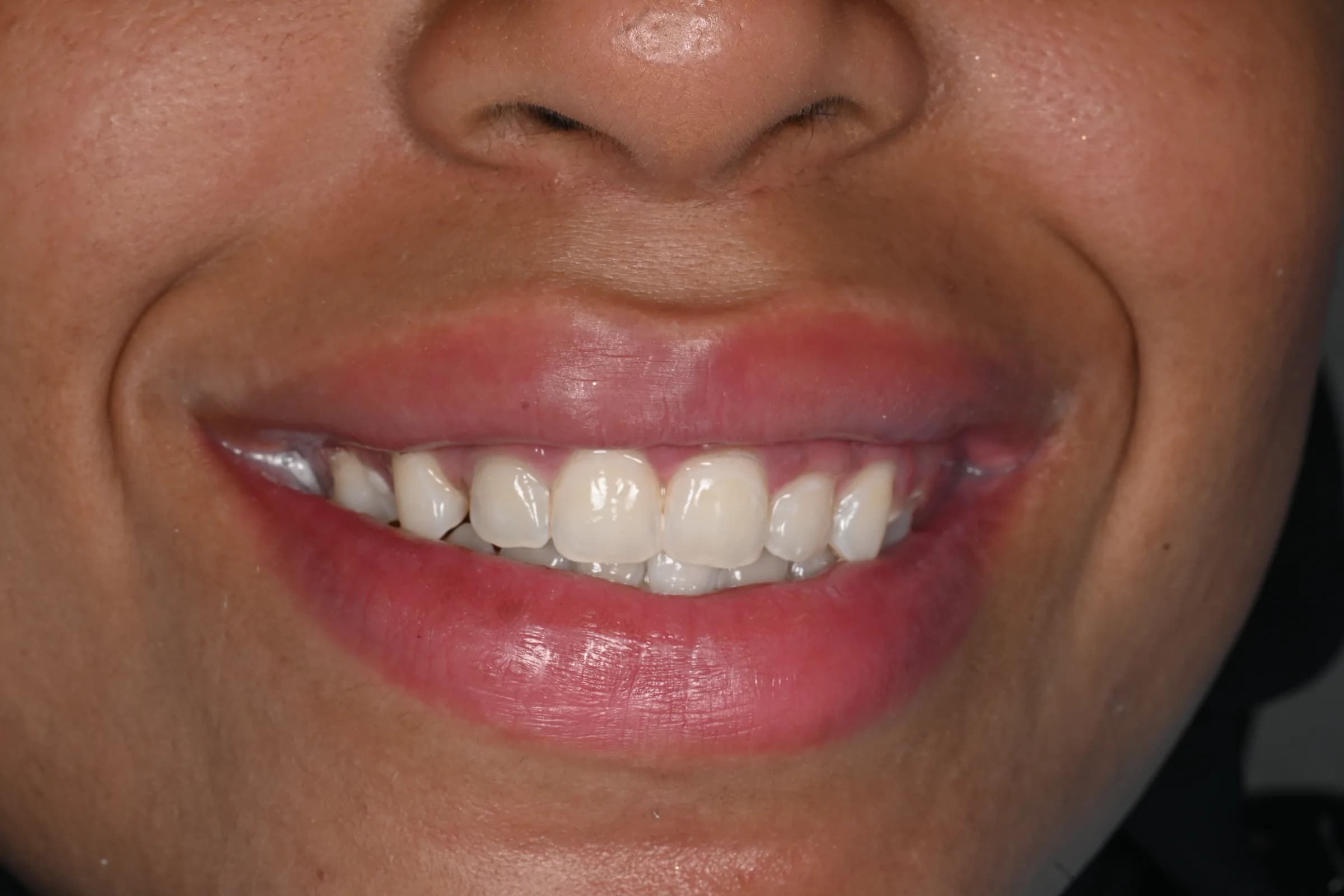 Whitening for a naturally brighter smile — after treatment