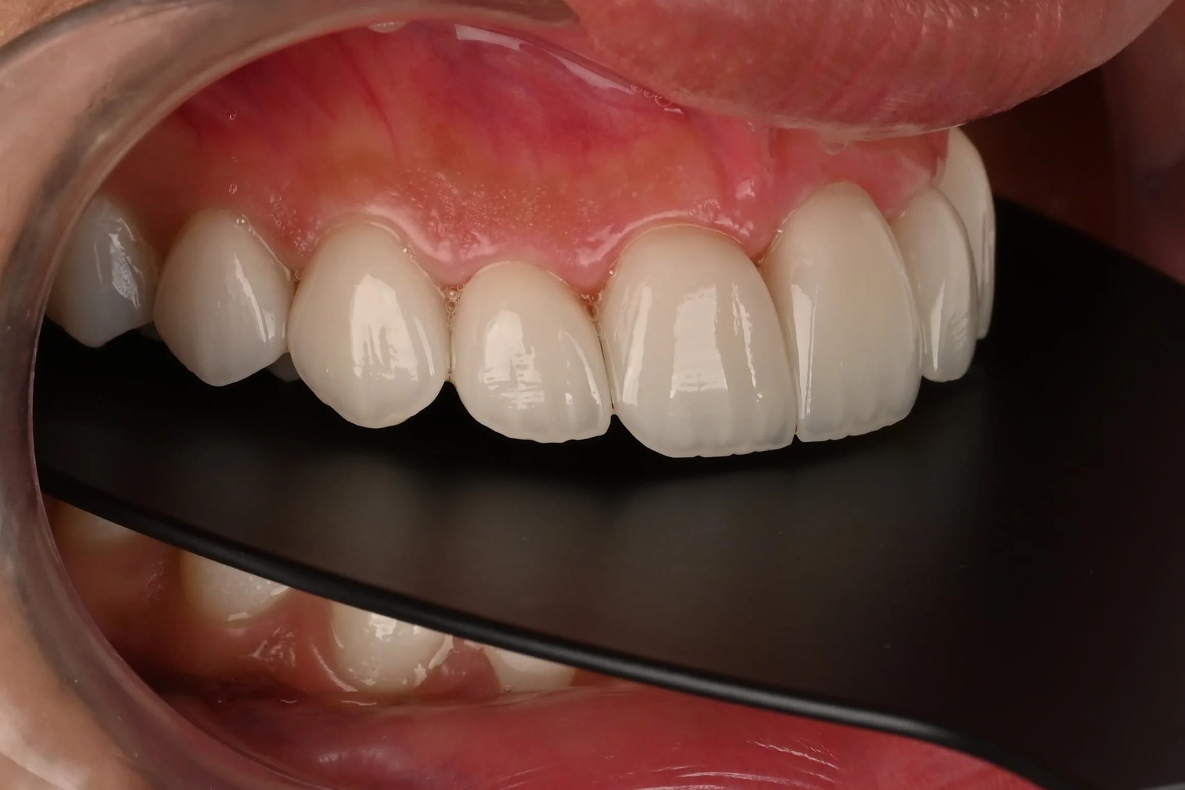 Veneers designed around the existing smile — after treatment