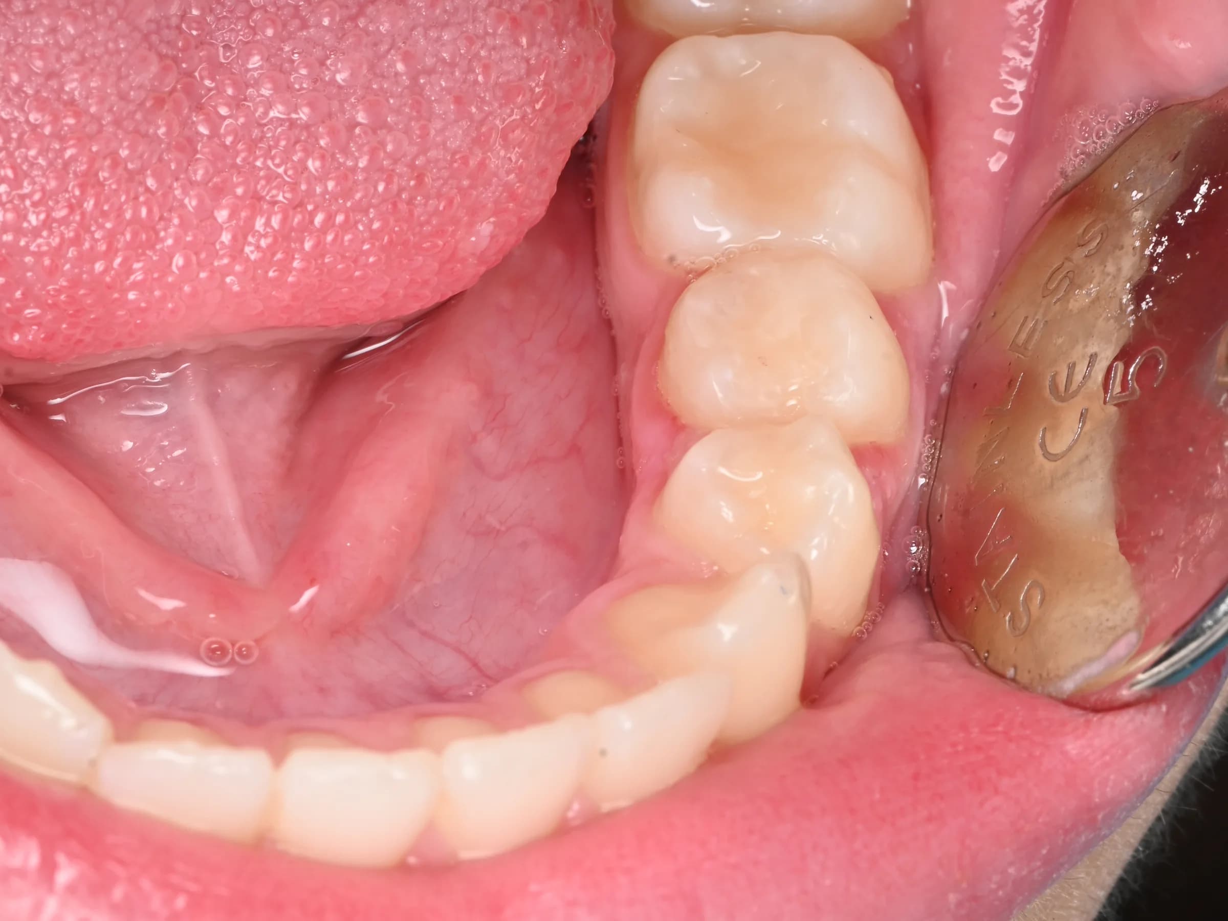 Restoring the biting surface — after treatment