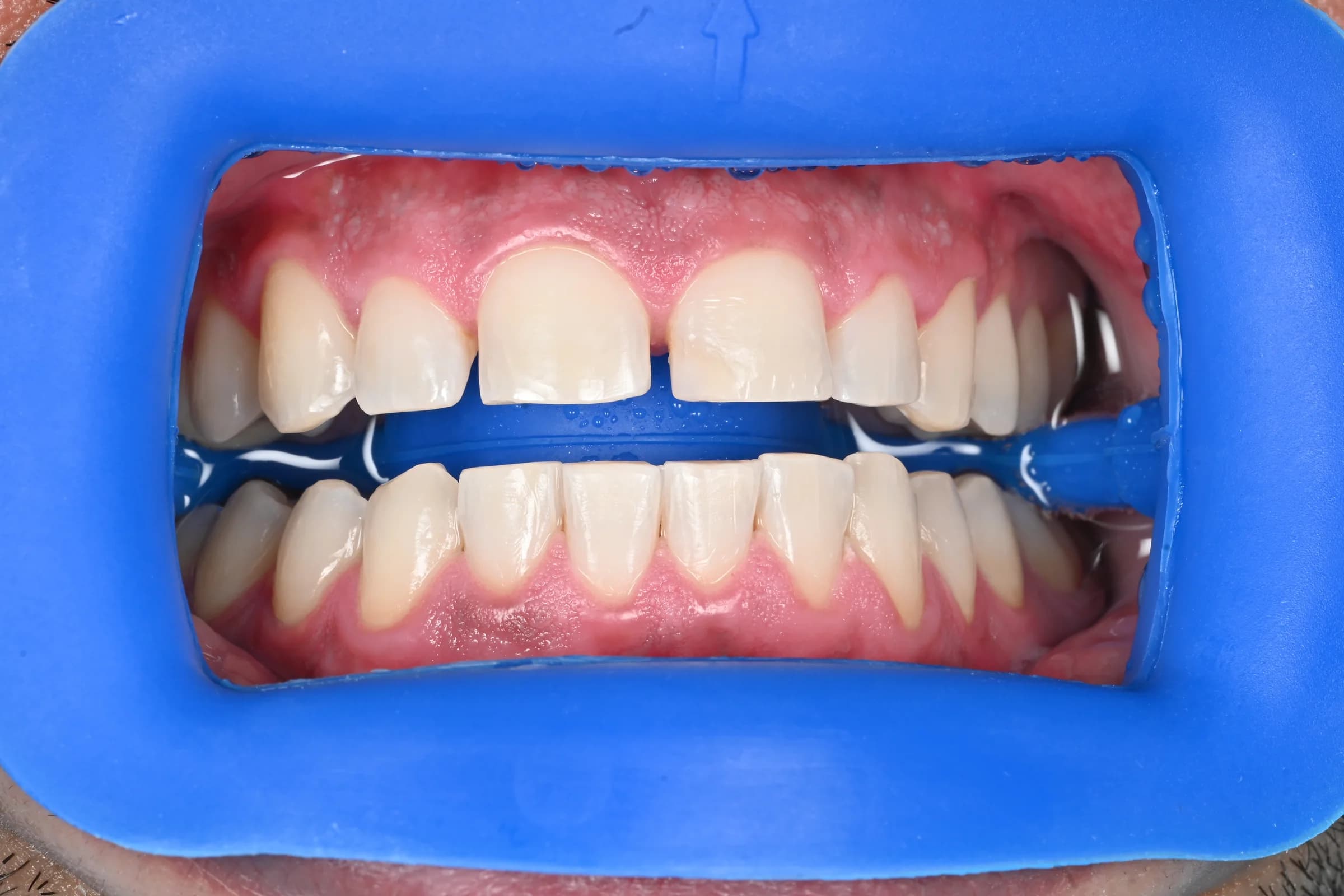 Whitening across both arches, shade matched — Upper and lower arches — after treatment