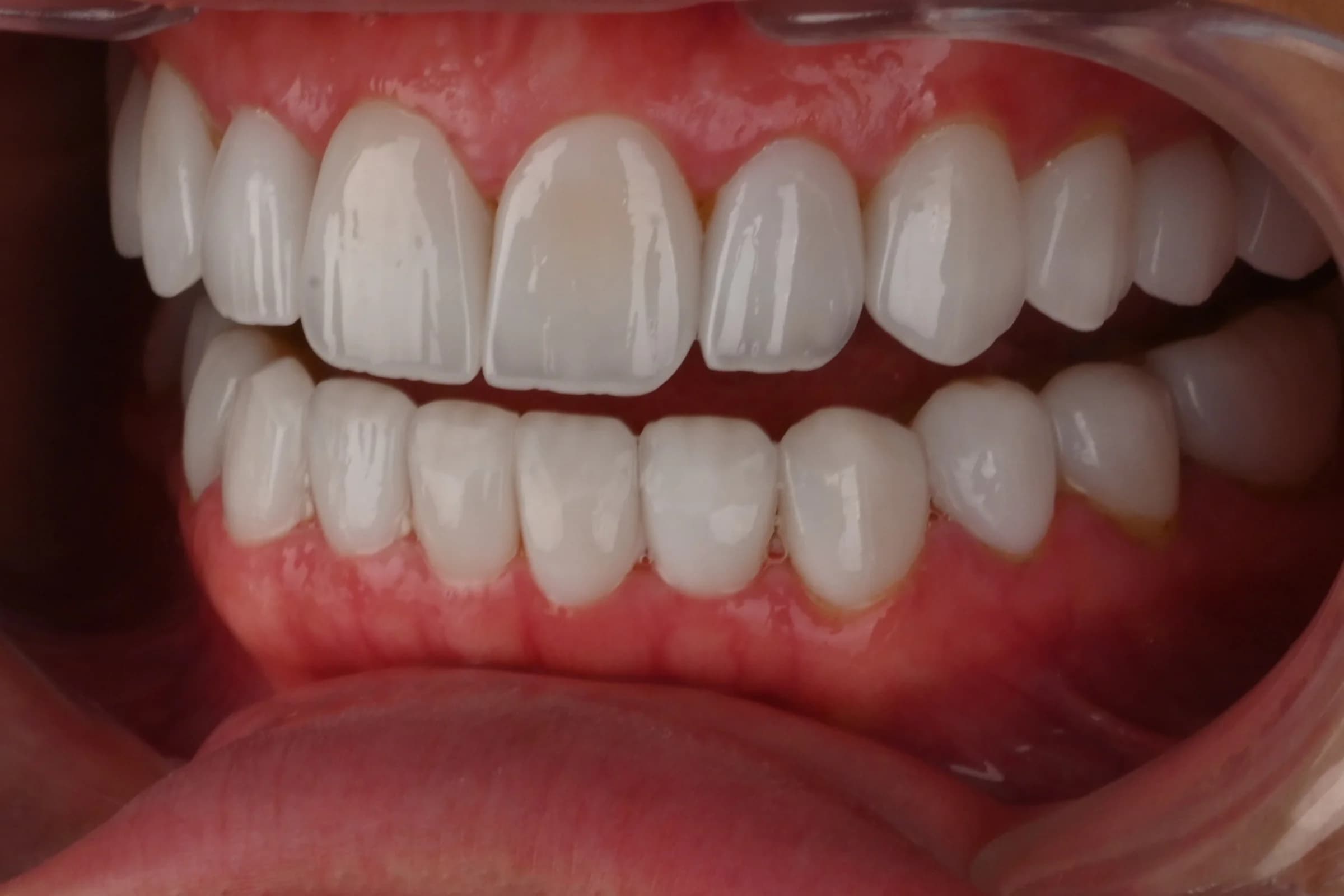 Veneers on the upper front teeth — after treatment