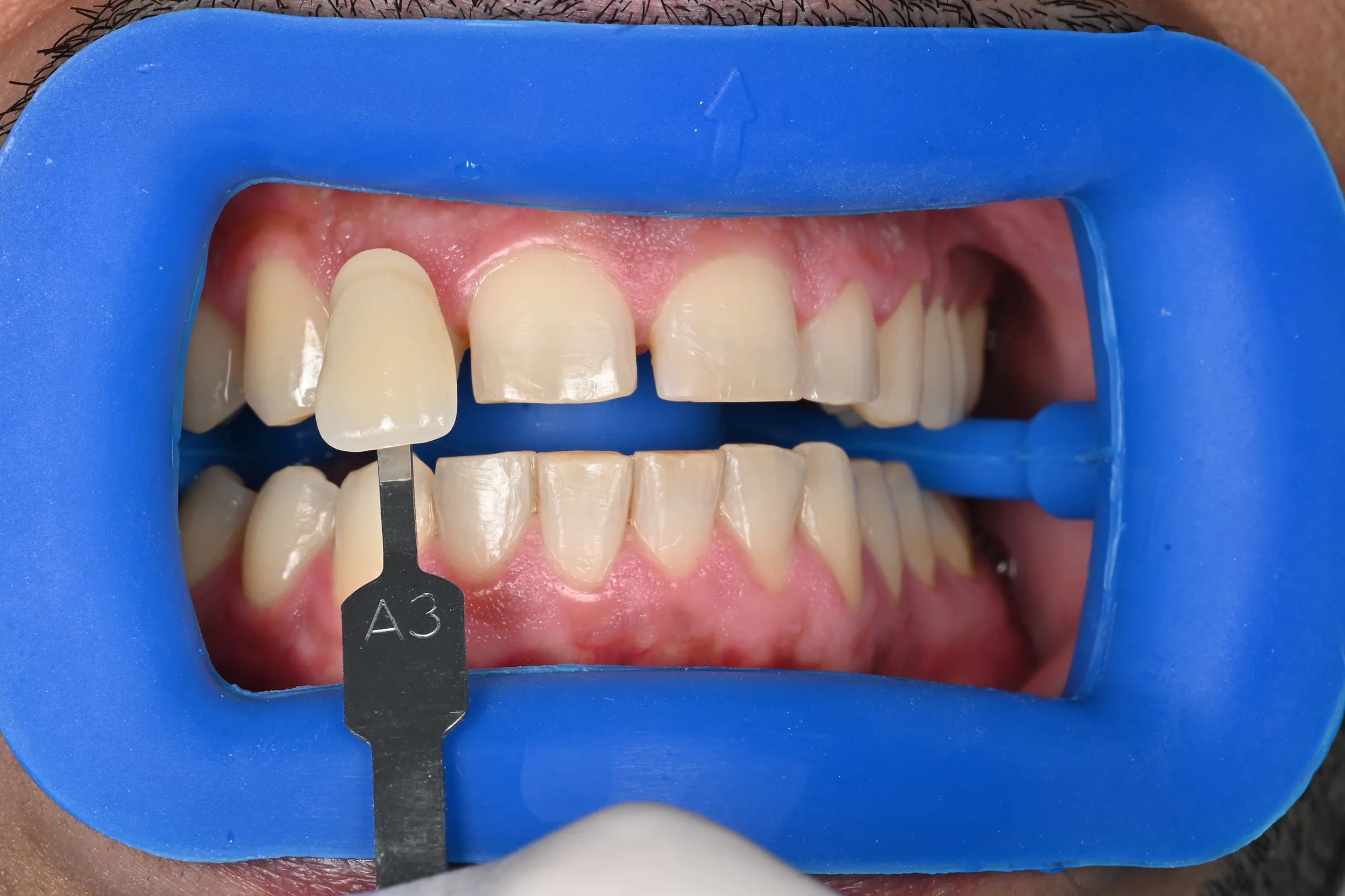 Whitening across both arches, shade matched — Shade recorded at the start — before treatment