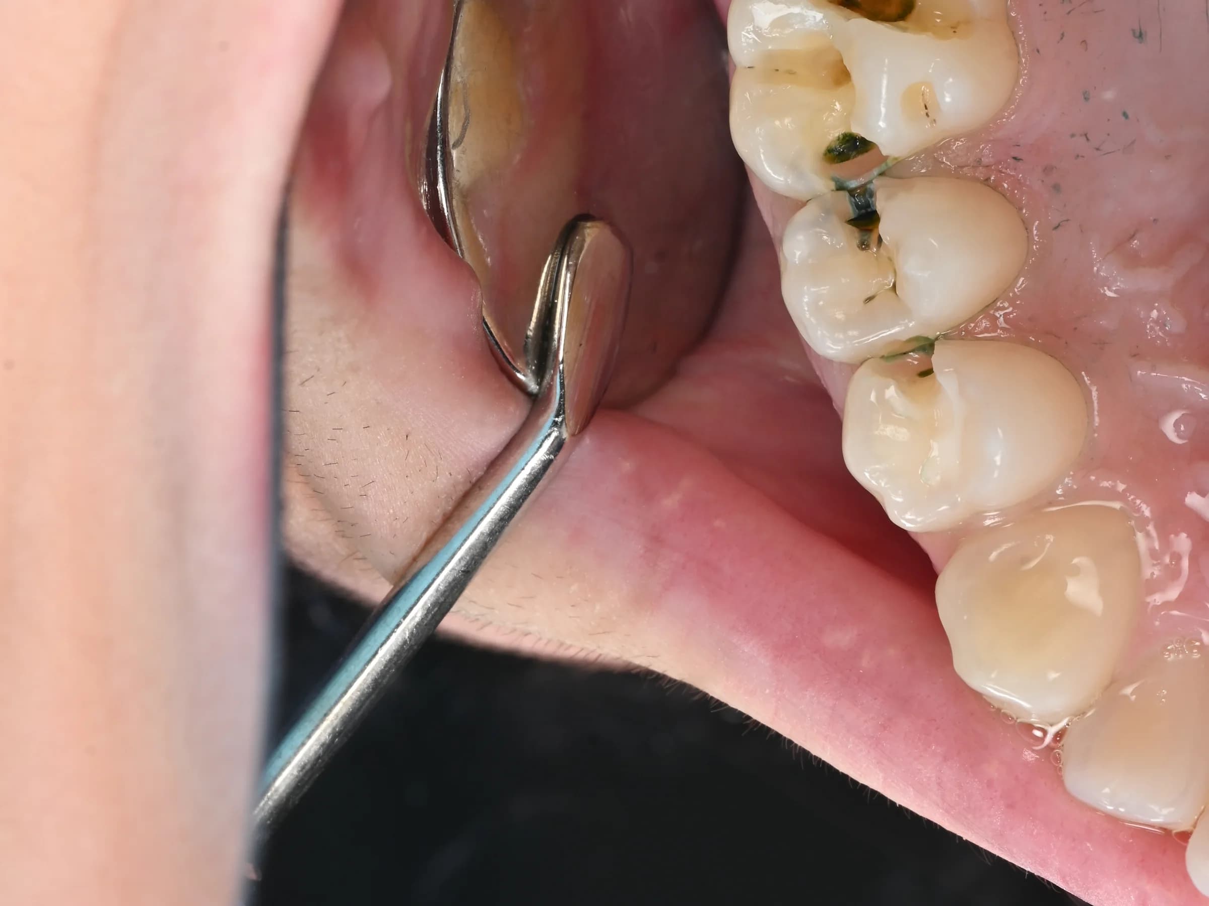 Repairing a back tooth without metal — before treatment
