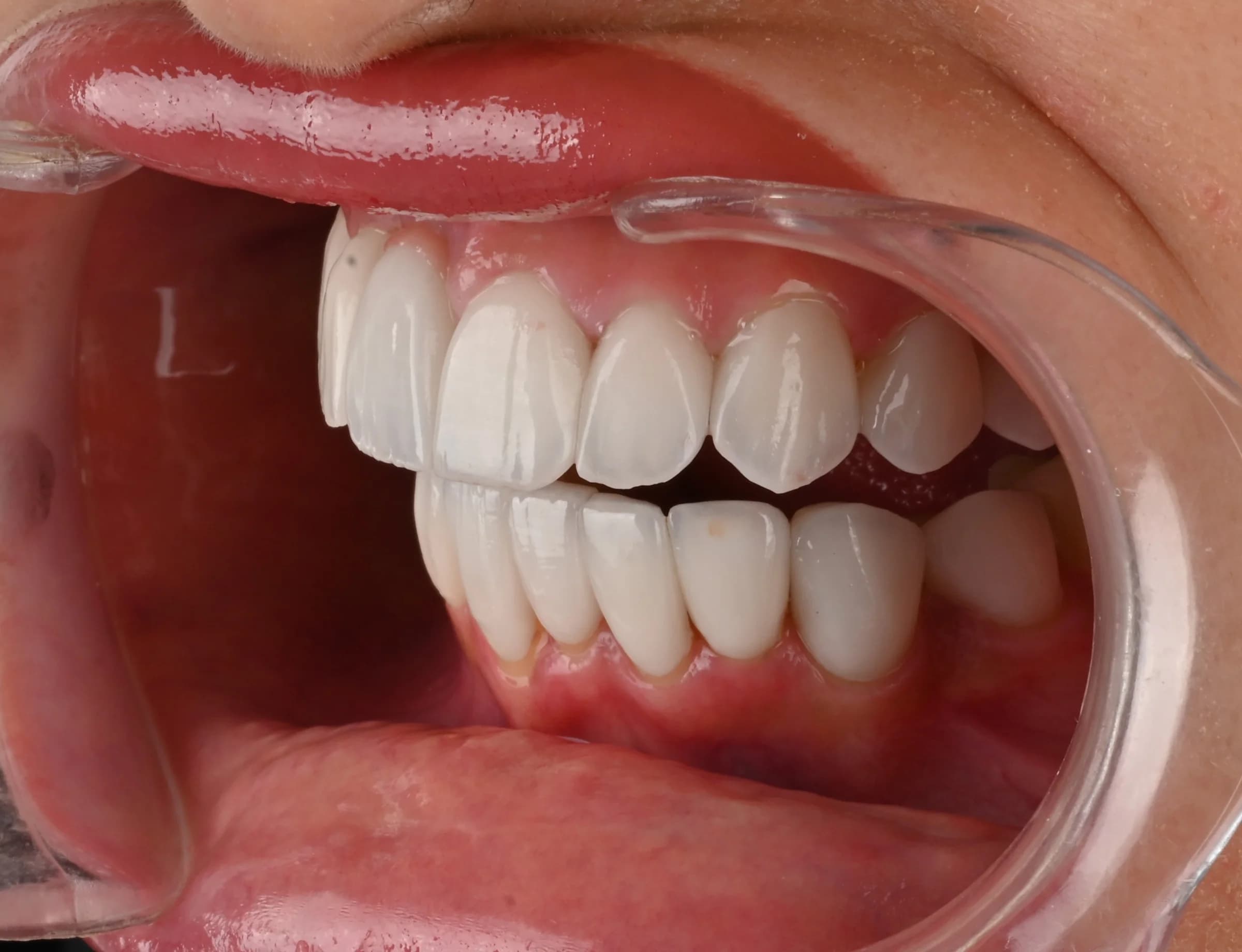 Veneers documented across five views — after treatment