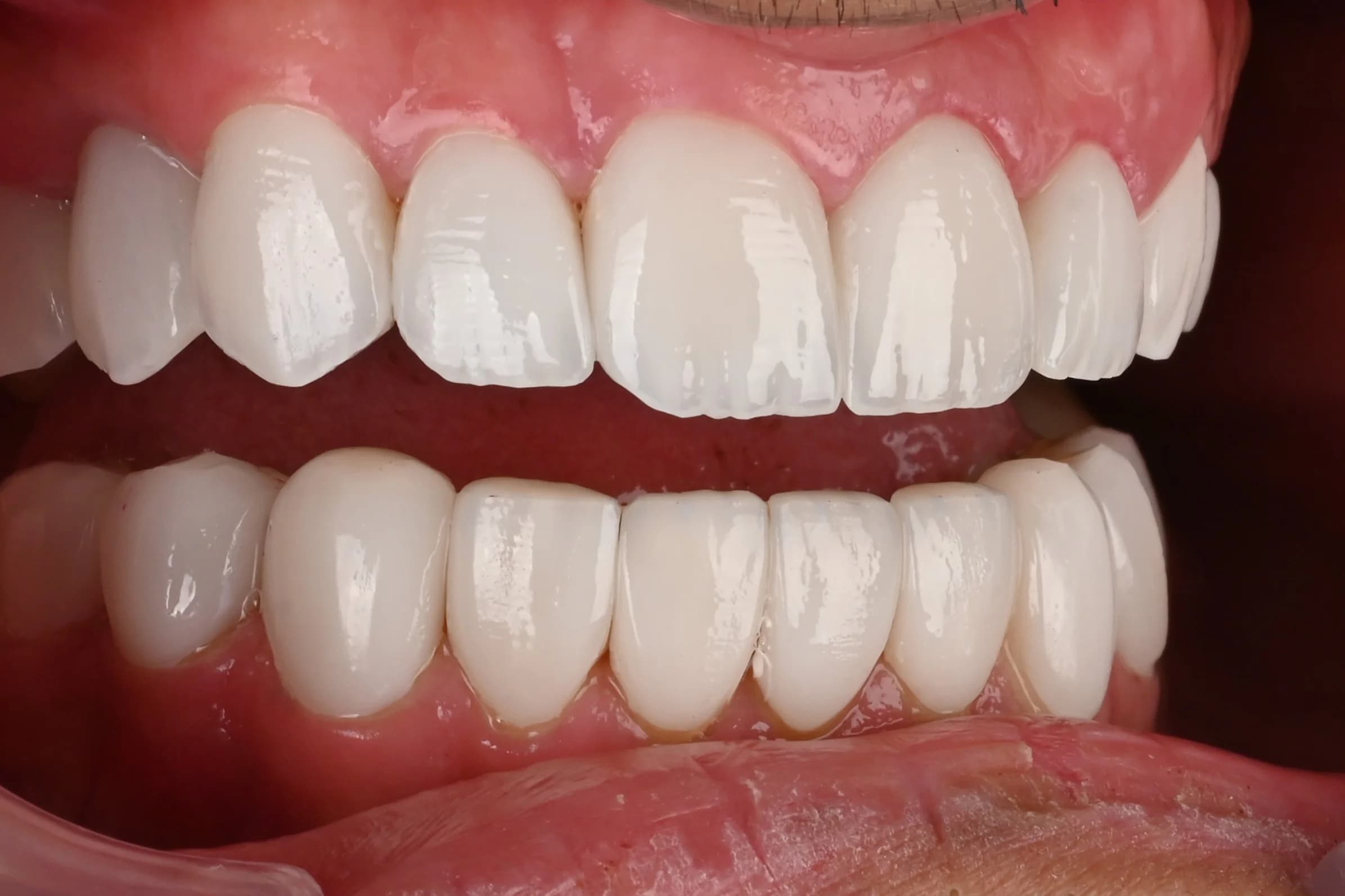A full veneer case, six views — after treatment