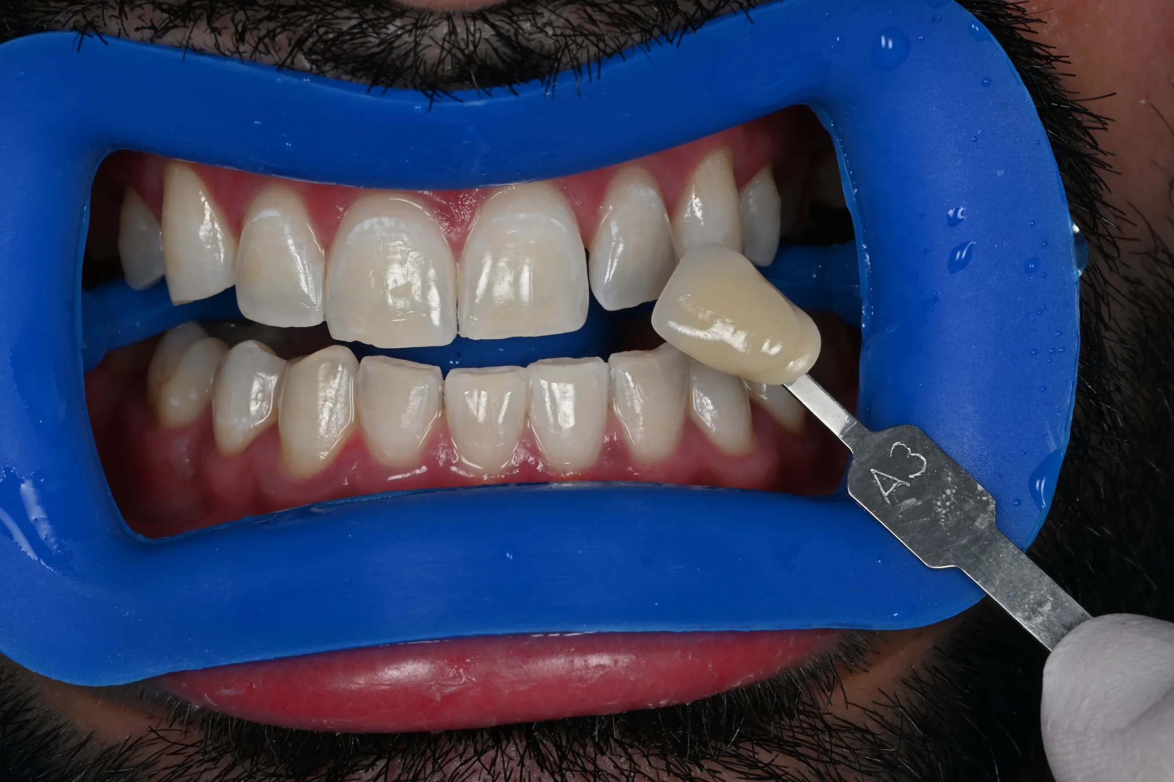 An even, natural whitening result — after treatment