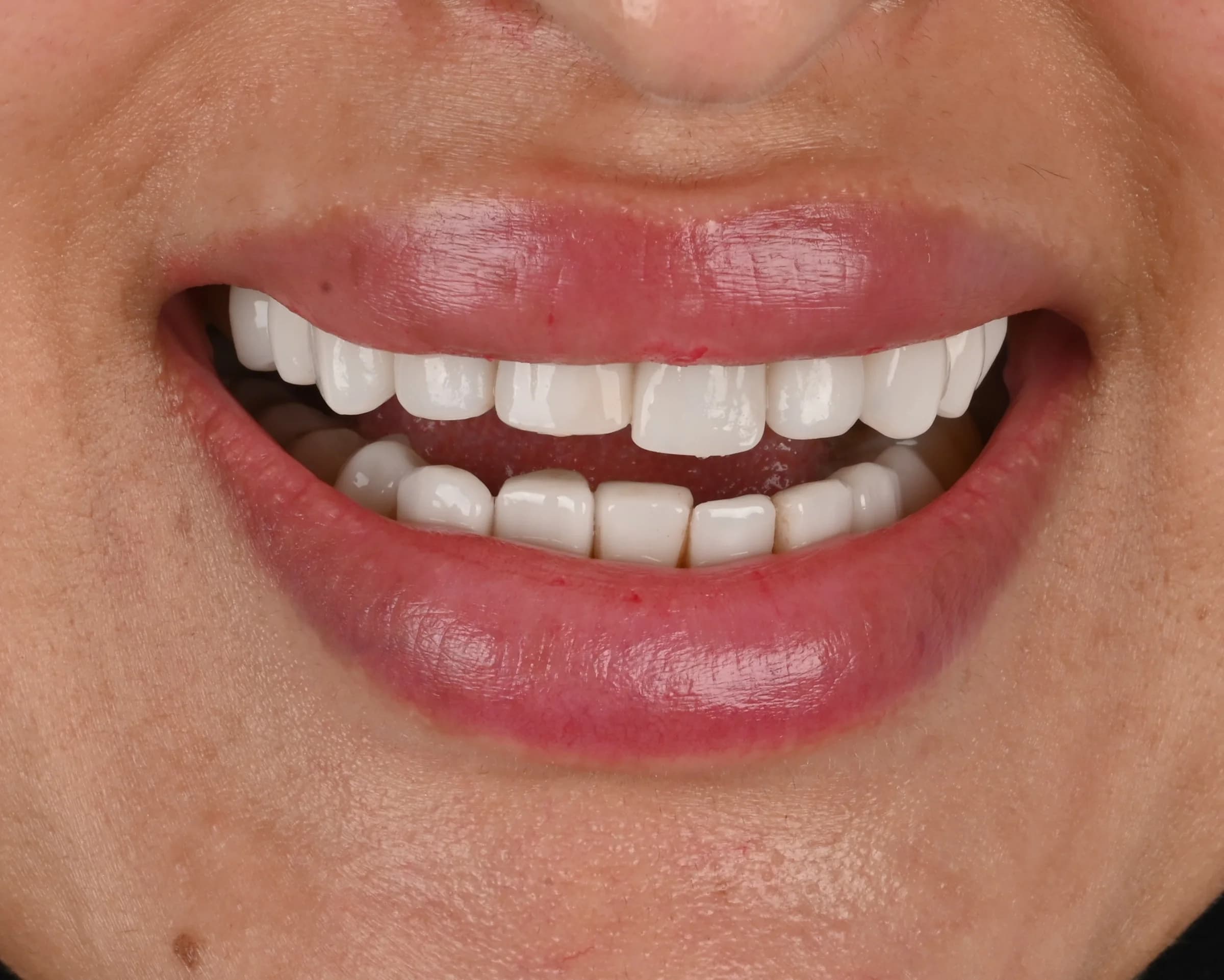 Veneers documented across five views — before treatment