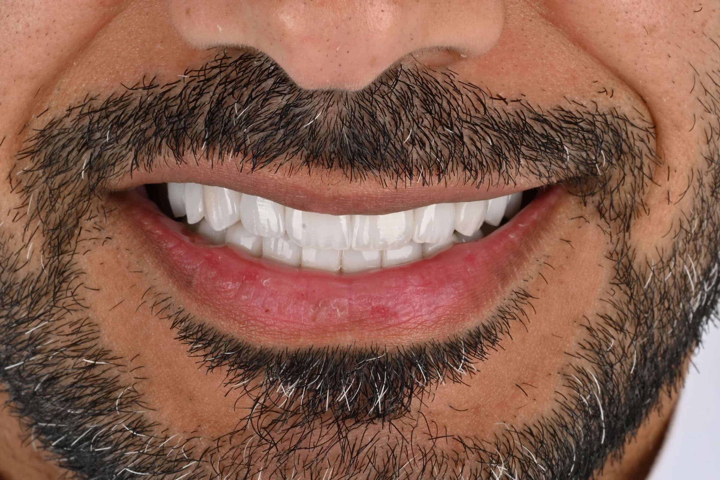 A full veneer case, six views — after treatment