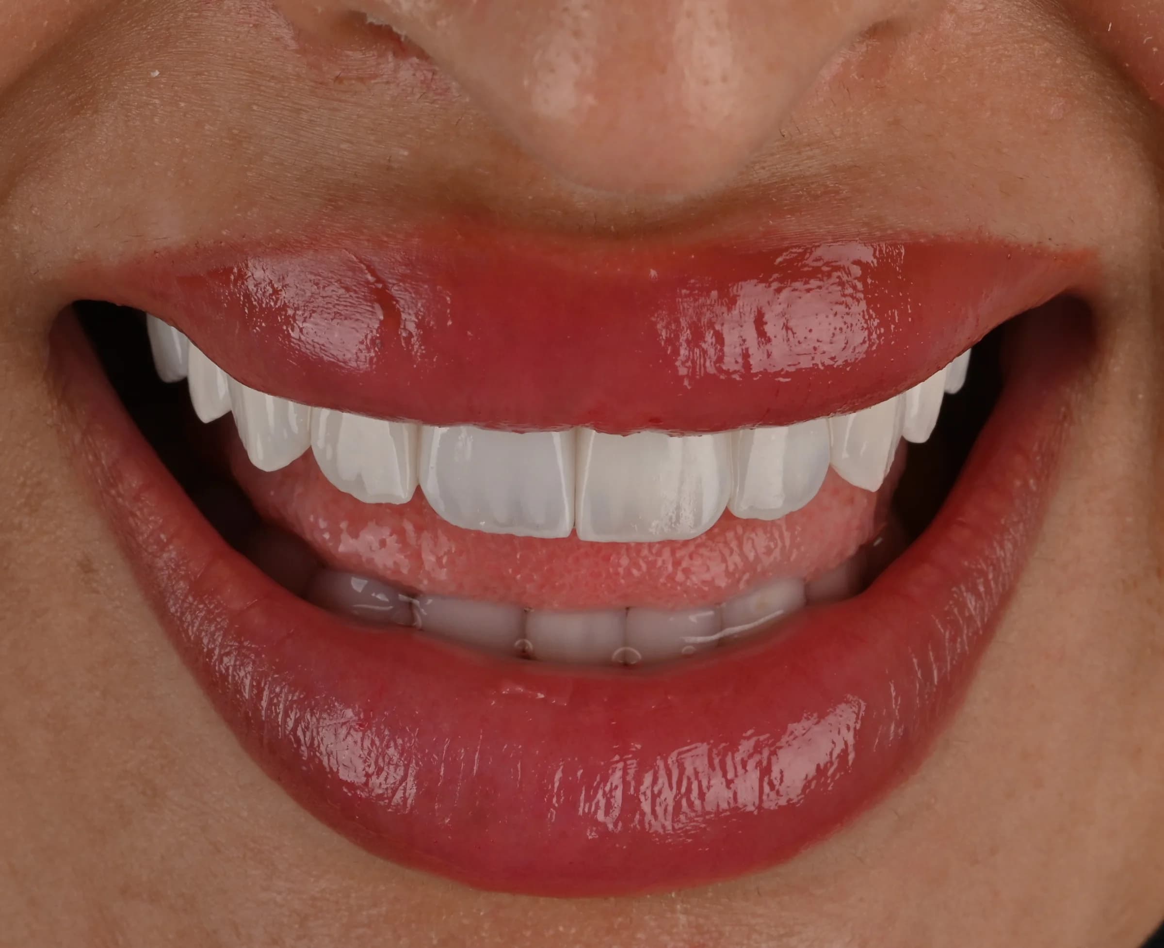 Veneers documented across five views — after treatment
