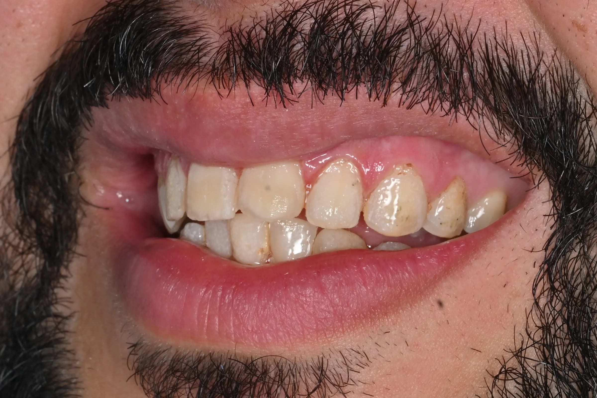 Rebuilding worn and uneven edges — before treatment
