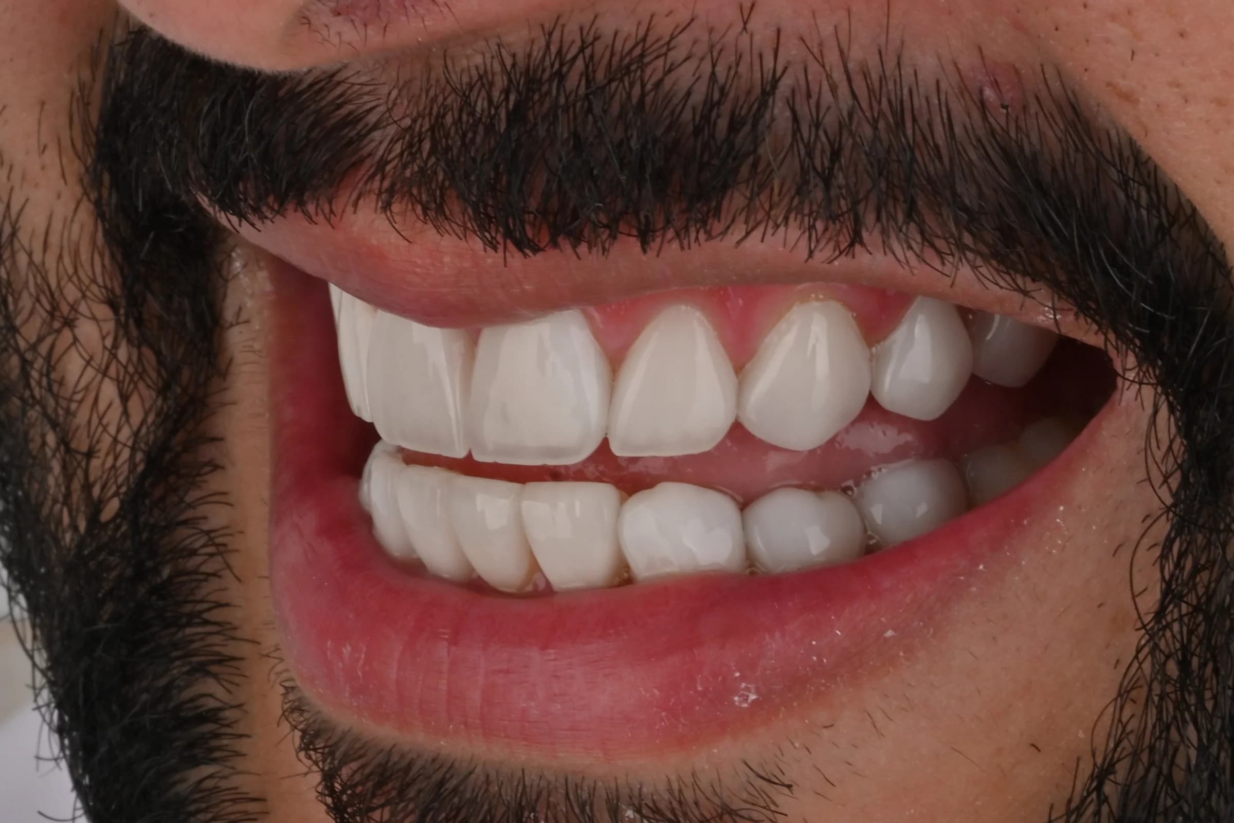 Rebuilding worn and uneven edges — after treatment