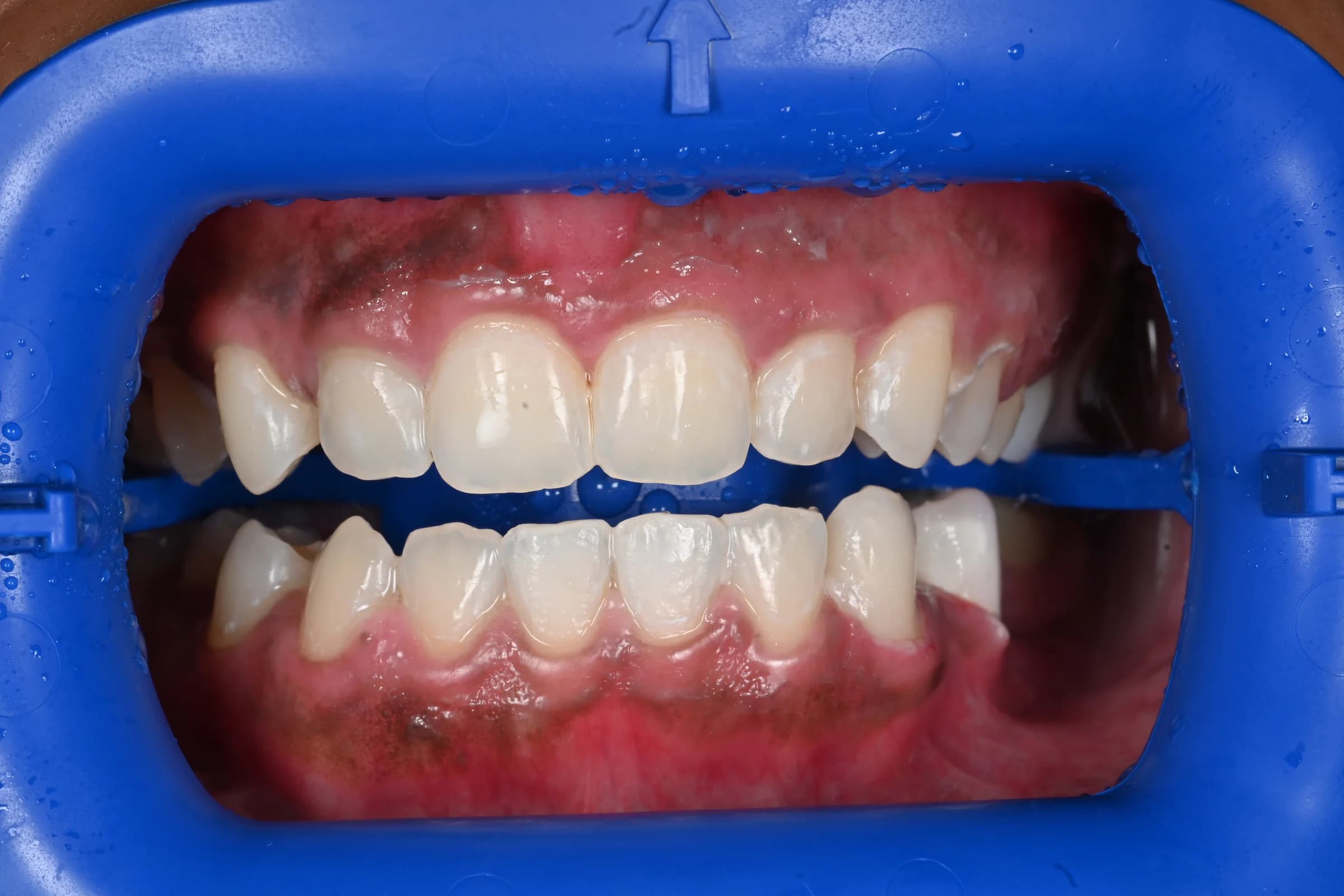 Professional teeth whitening — after treatment