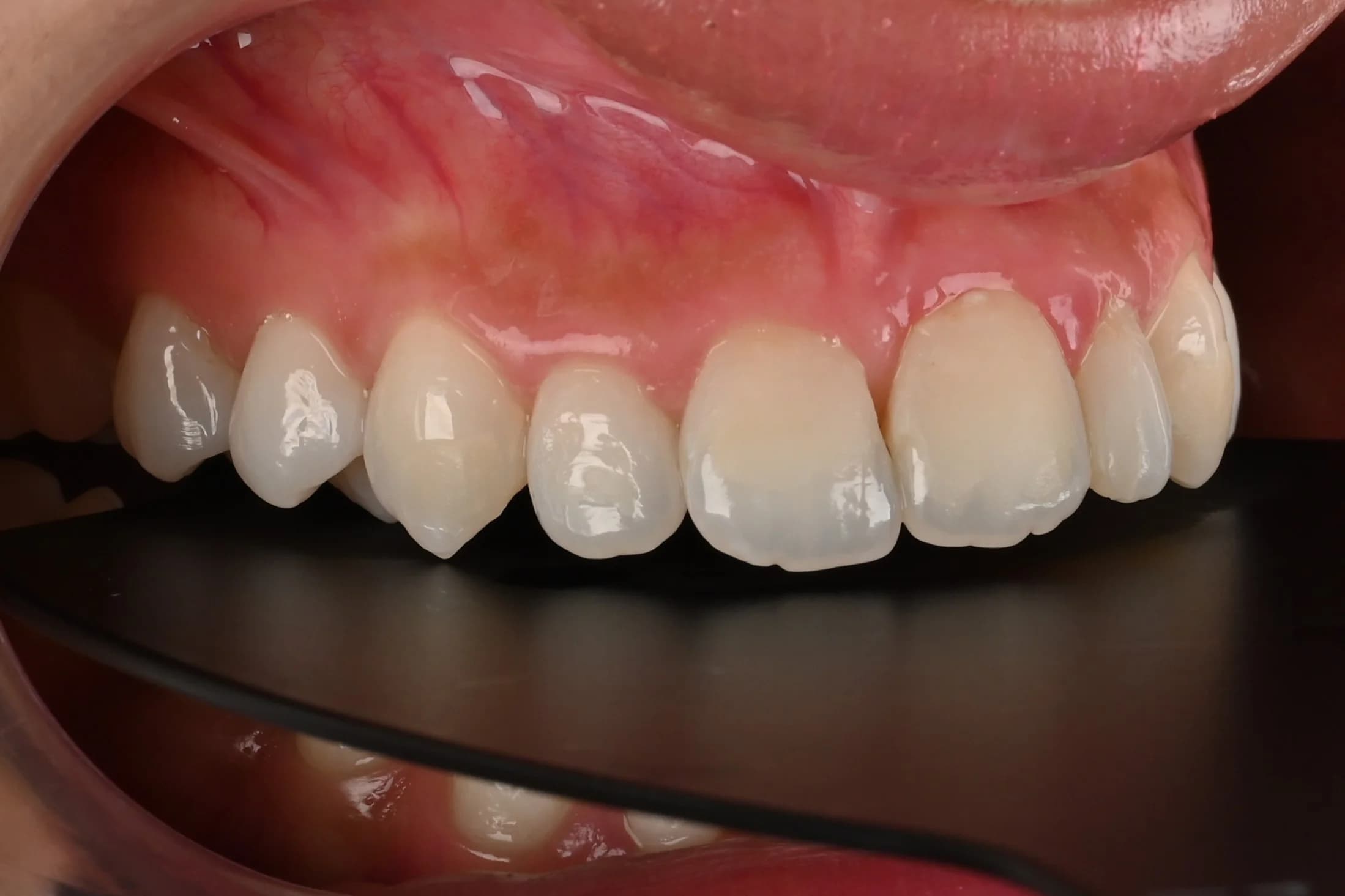 Veneers designed around the existing smile — before treatment