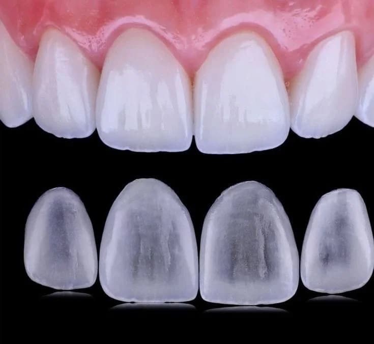 Non-prep veneers