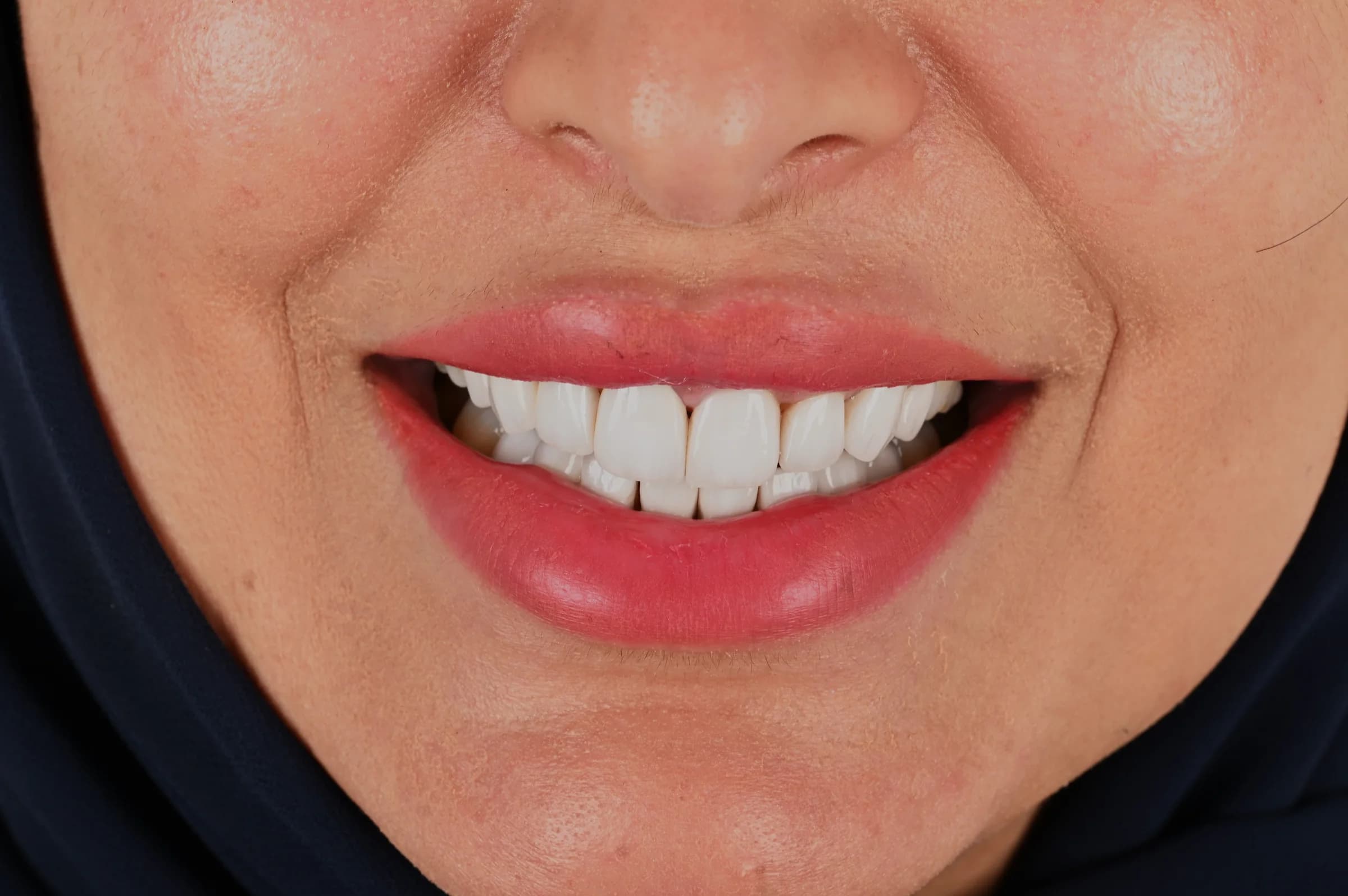Porcelain veneers, upper and lower — before treatment
