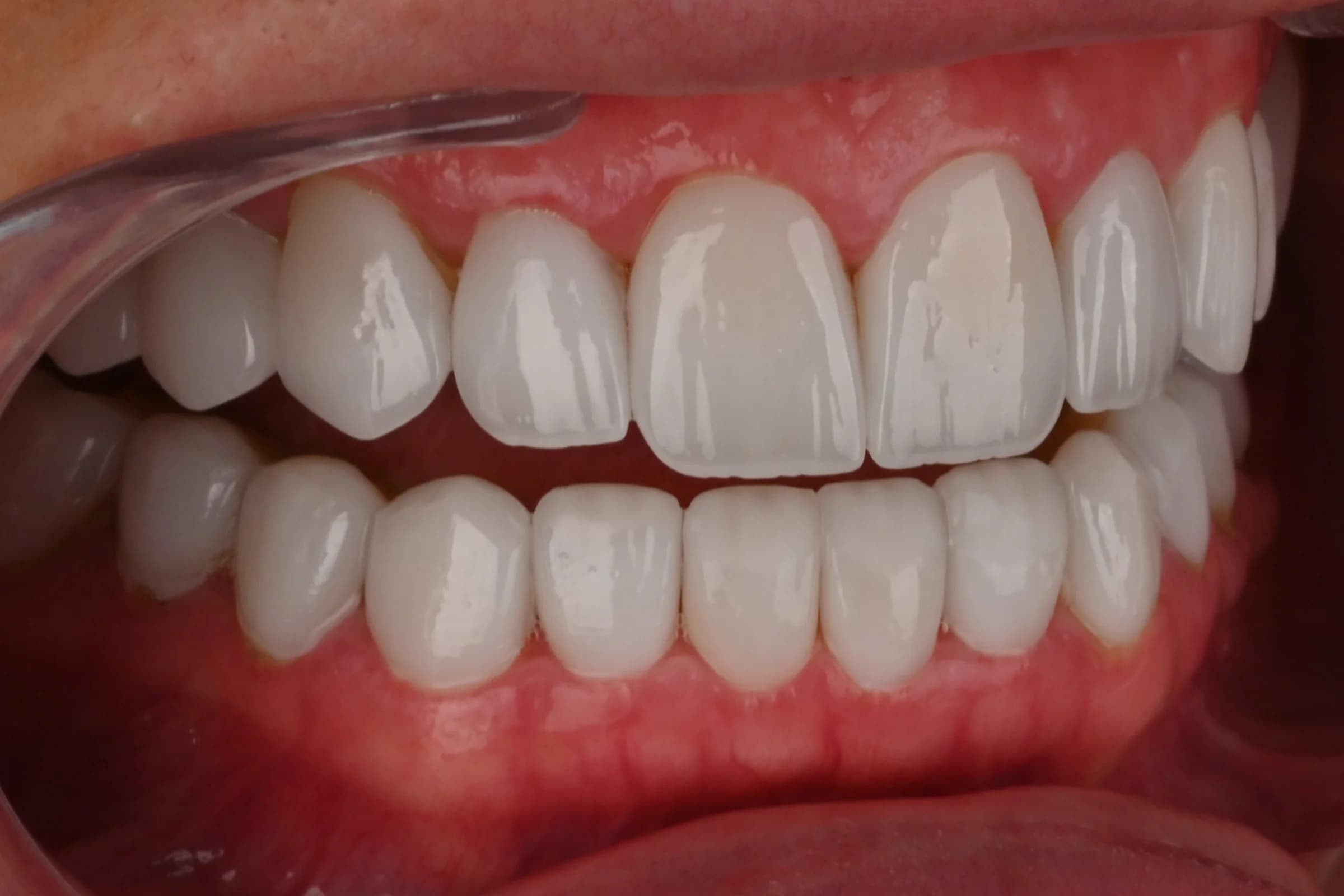 Veneers on the upper front teeth — after treatment