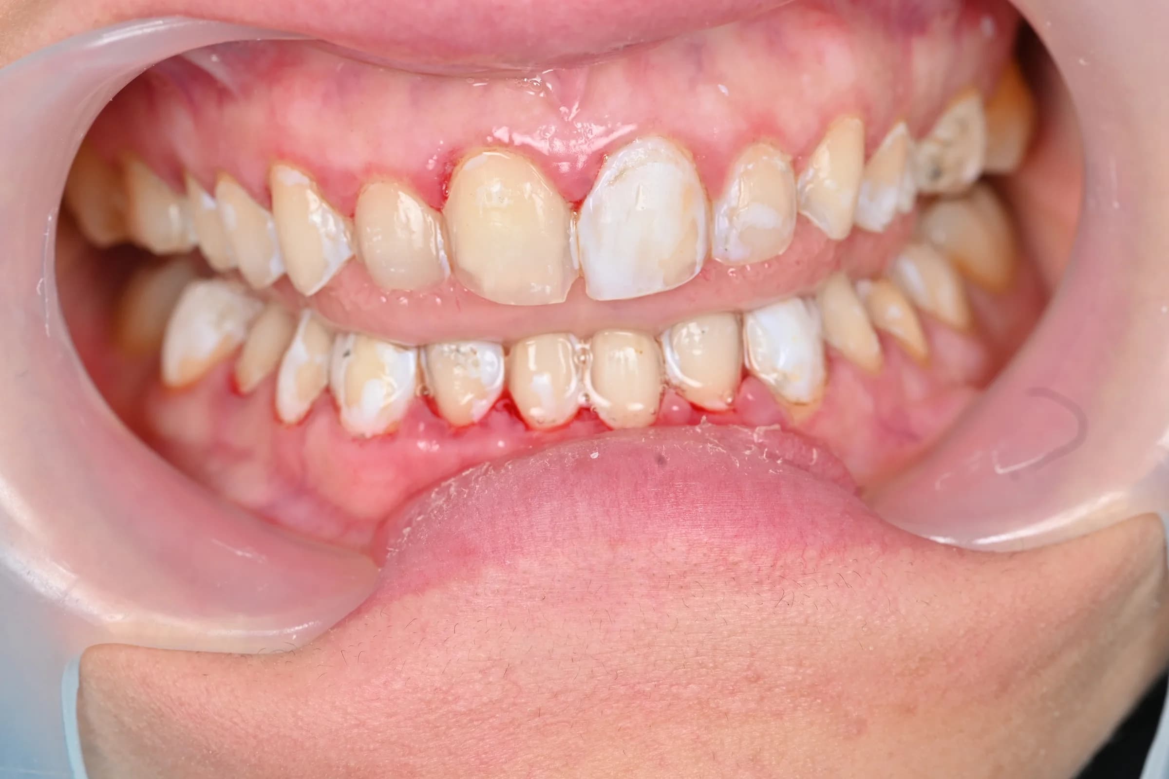 Veneers on the upper front teeth — before treatment