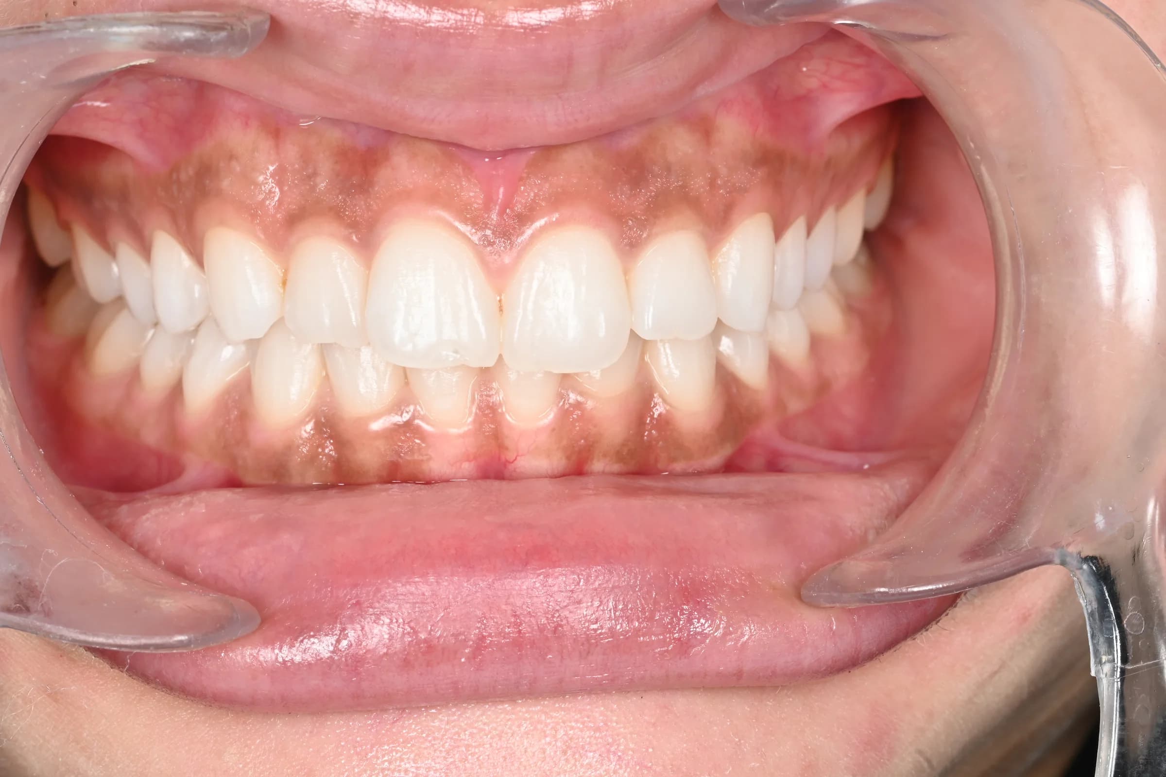 Evening out an uneven gum line — after treatment