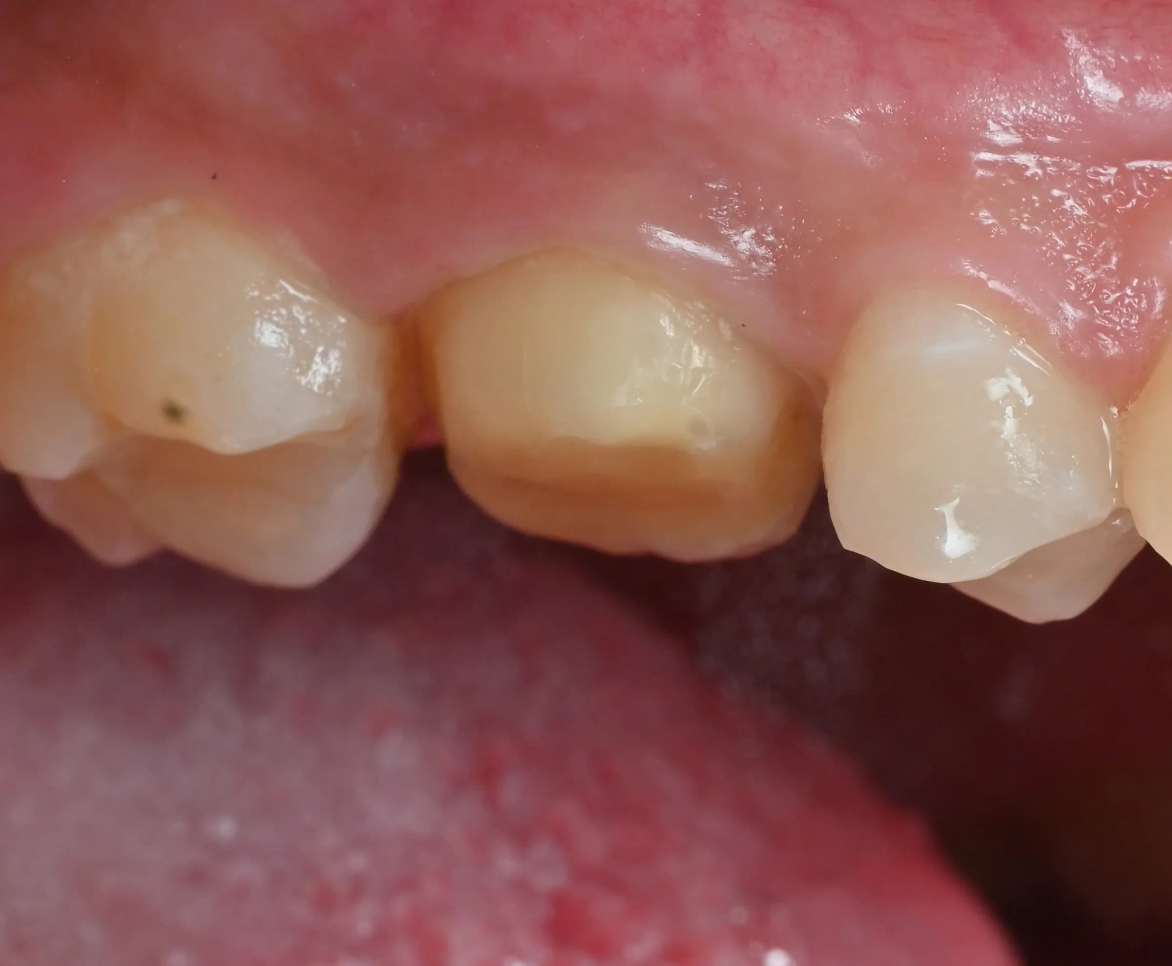 Rebuilding a worn tooth — before treatment
