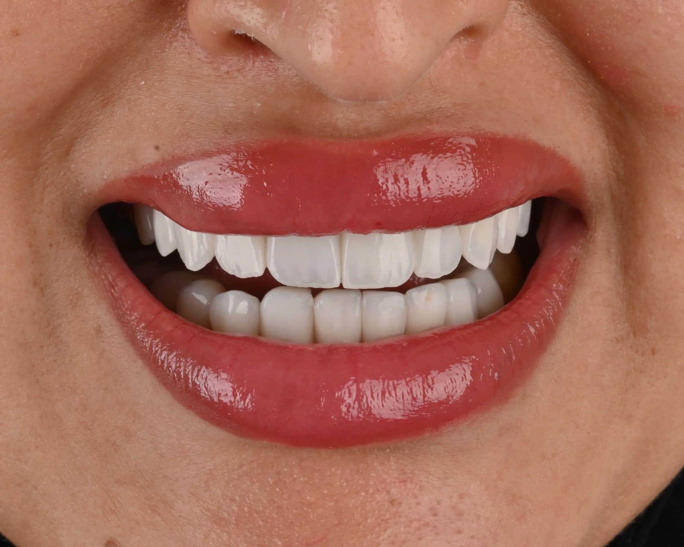 Veneers documented across five views — after treatment
