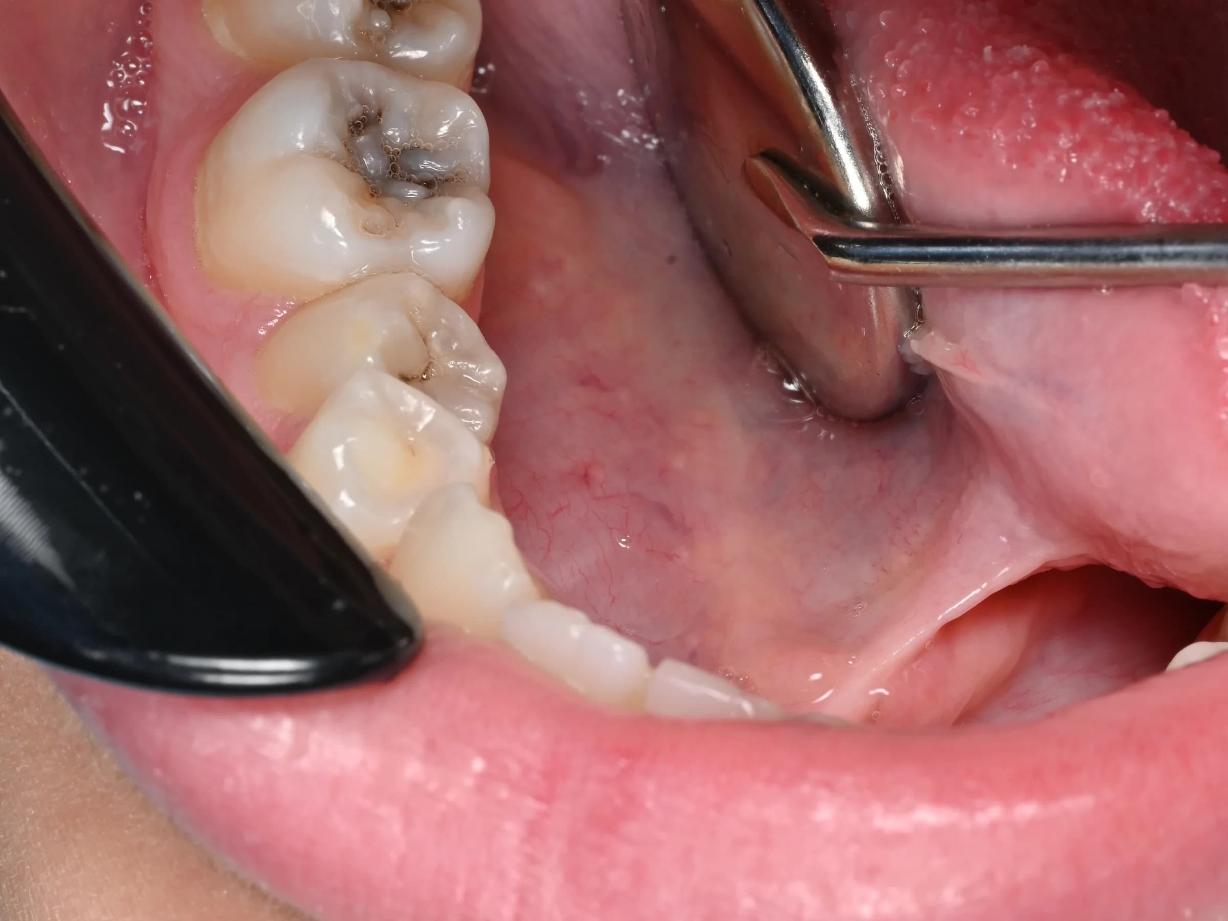 Decay removed, molars rebuilt — before treatment