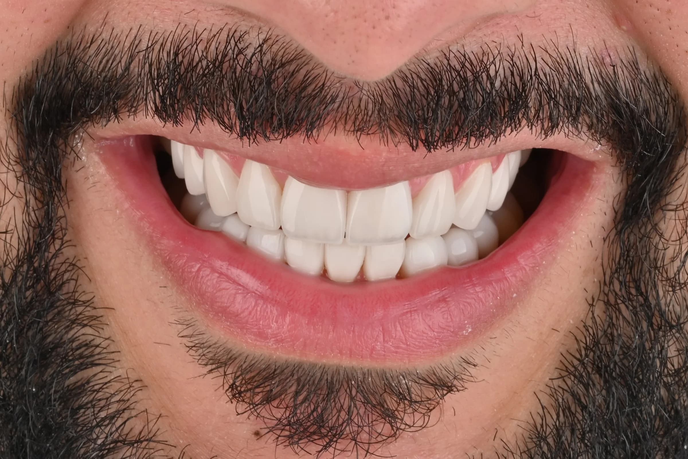 Rebuilding worn and uneven edges — after treatment