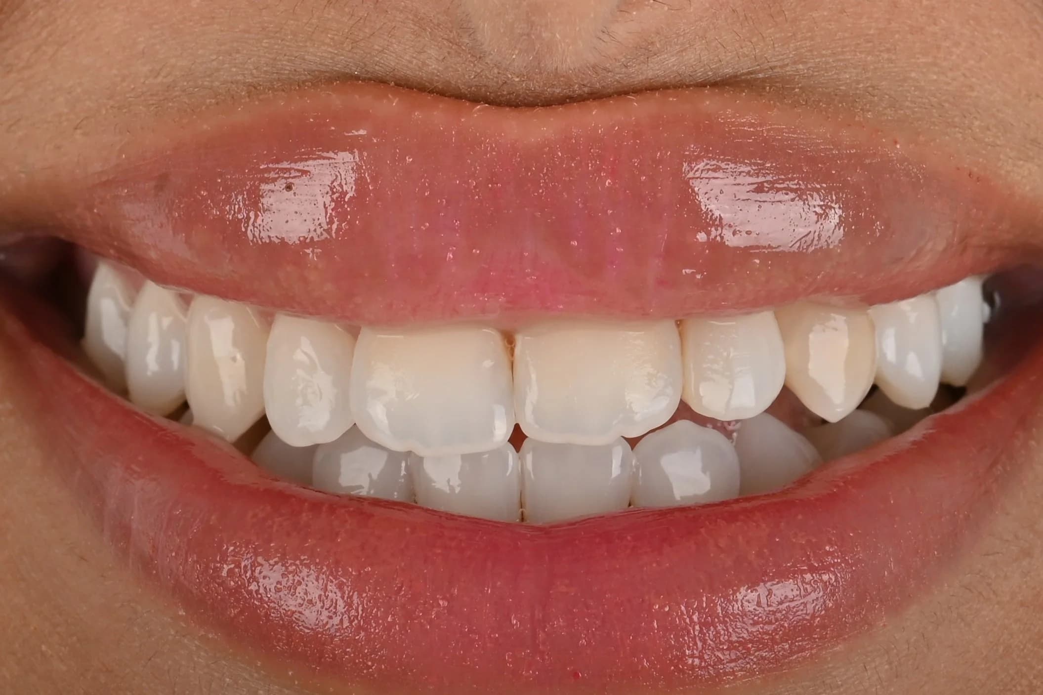Veneers designed around the existing smile — before treatment