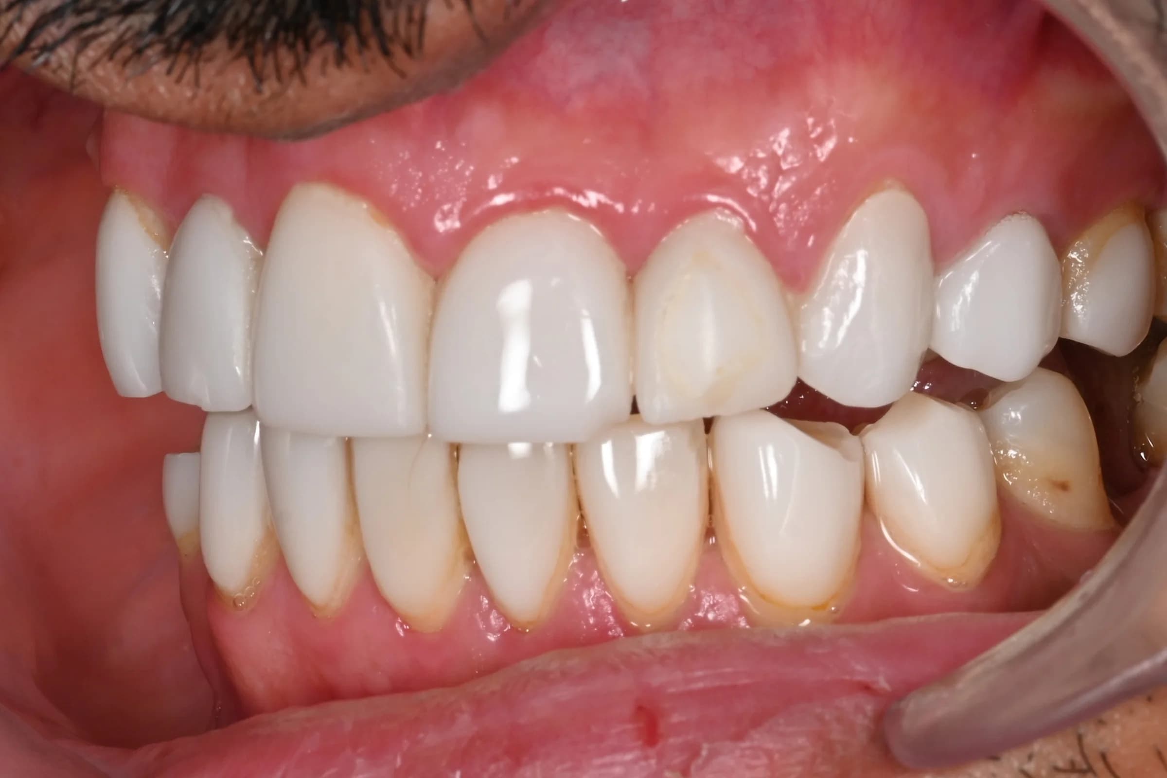 A full veneer case, six views — before treatment