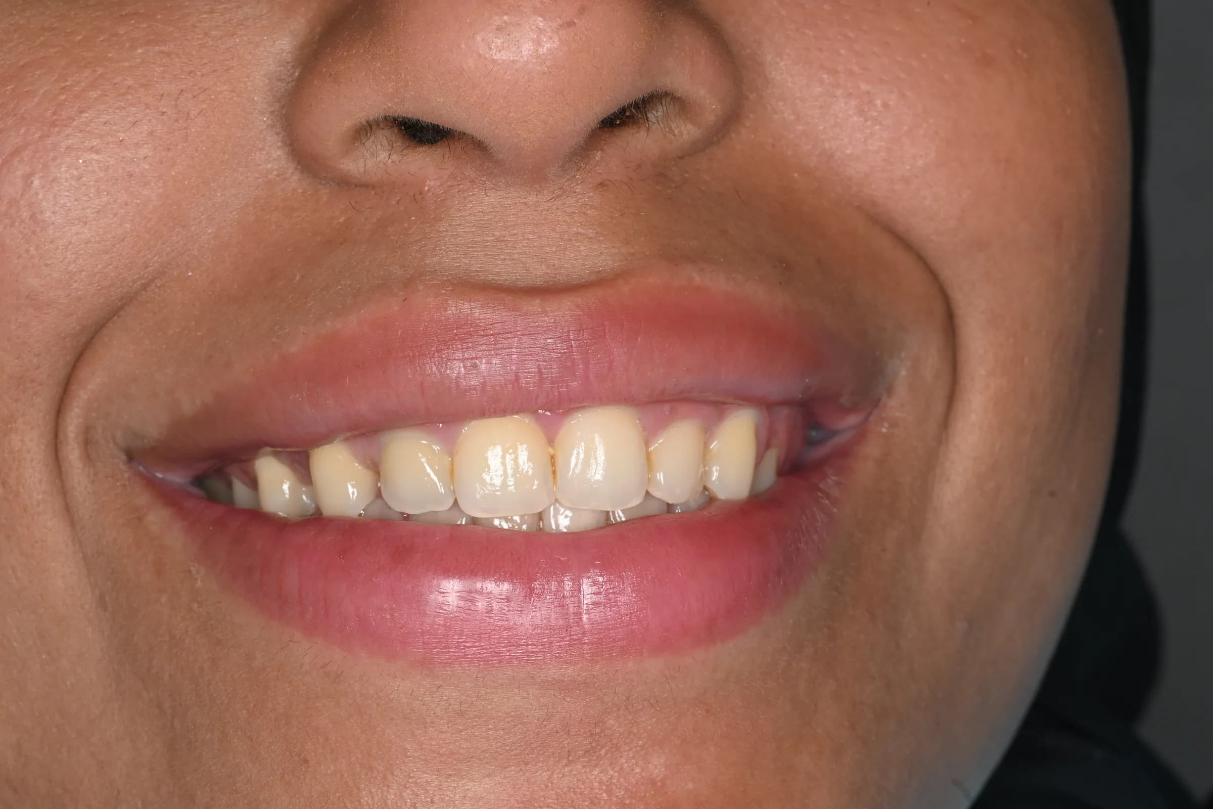 Whitening for a naturally brighter smile — before treatment